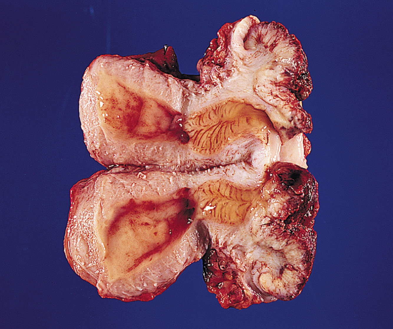 Fig. 43.8, Gross pathologic findings of cervical squamous cell carcinoma.