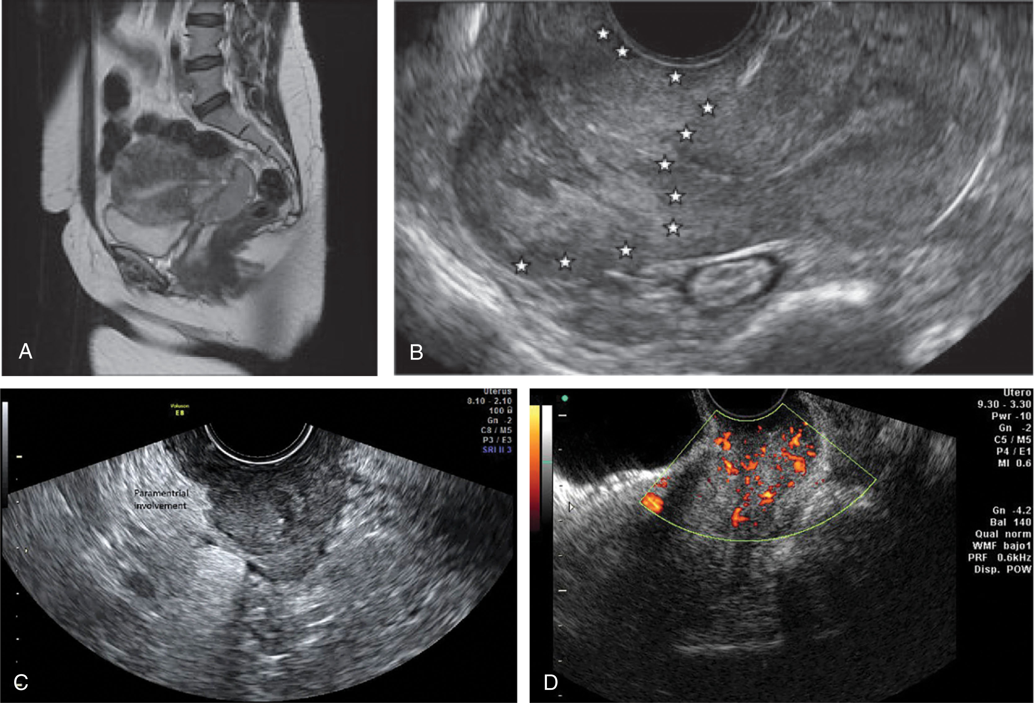 Fig. 43.9, Magnetic resonance (A–B) and transvaginal ultrasound (C) images of the lower uterine segment. The cervical area is enlarged and hypoechoic with decreased through transmission. (D) Color Doppler demonstrates increased vascularity in the mass. Sonography may demonstrate a solid retrovesical mass, which may be indistinguishable from a cervical myoma.