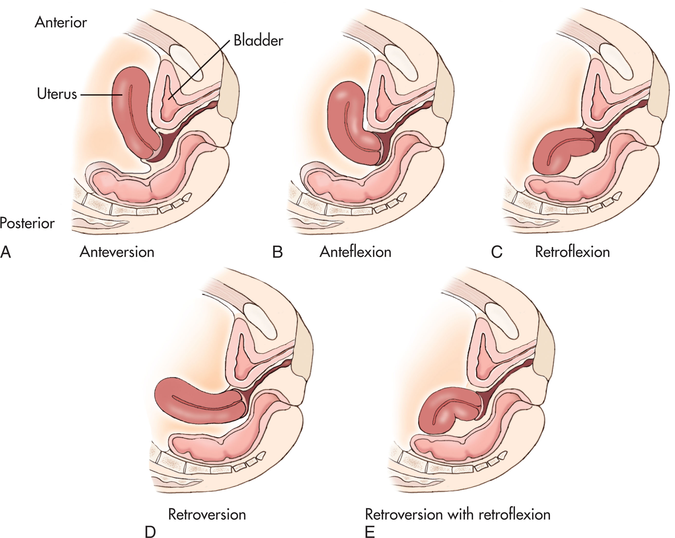 Fig. 43.10, Variations in uterine position.