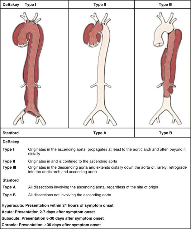 Fig. 32.1, Aortic dissection type according to the DeBakey and Stanford classification systems.