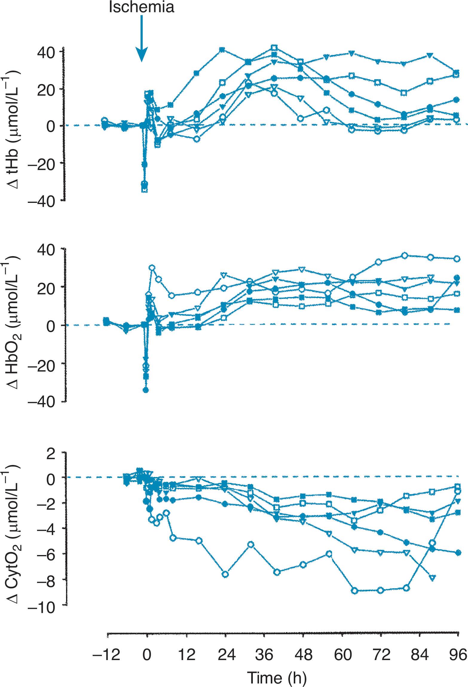 Fig. 16.8, Cerebral hemodynamic changes after transient cerebral ischemia in the late-gestation fetal lamb. Changes in total cerebral hemoglobin (tHb) , oxygenated hemoglobin (HbO 2 ) , and cytochrome oxidase (CytO 2 ) were measured by near-infrared spectroscopy. In each graph, different symbols represent data from separate fetuses. Note the two phases of cerebral vasodilation and increased cerebral blood flow, as assessed by the hemoglobin signals; the early increase occurs in the first 2 to 3 hours after ischemia, and the delayed increase occurs from 12 to 48 hours. The delayed increase in flow is accompanied by a decline in CytO 2 , consistent with impaired mitochondrial oxygenation.
