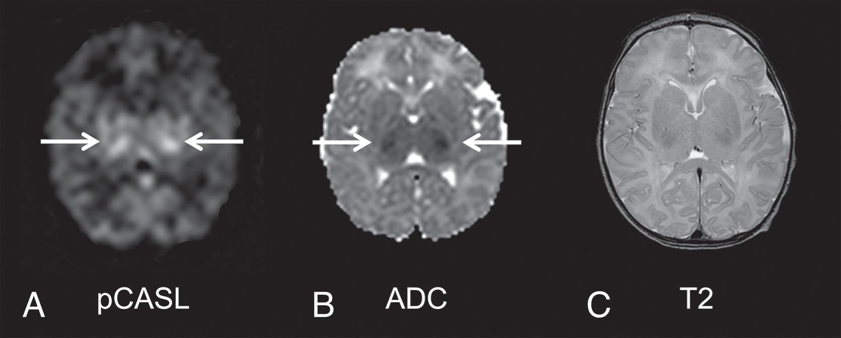 Fig. 16.9, An asphyxiated newborn treated with hypothermia showing basal ganglia injury on magnetic resonance imaging (MRI) obtained on day 2 of life. (A), Cerebral blood flow map obtained by pseudocontinuous arterial spin labeling (pCASL) , showing higher perfusion (arrows) in the bilateral thalami and, to a lesser extent, in the bilateral posterior limb of internal capsule and lentiform nuclei. (B) Apparent diffusion coefficient map showing restricted diffusion (arrows) within the same areas. (C) Axial T2-weighted image; changes of T2-weighted images are subtle.