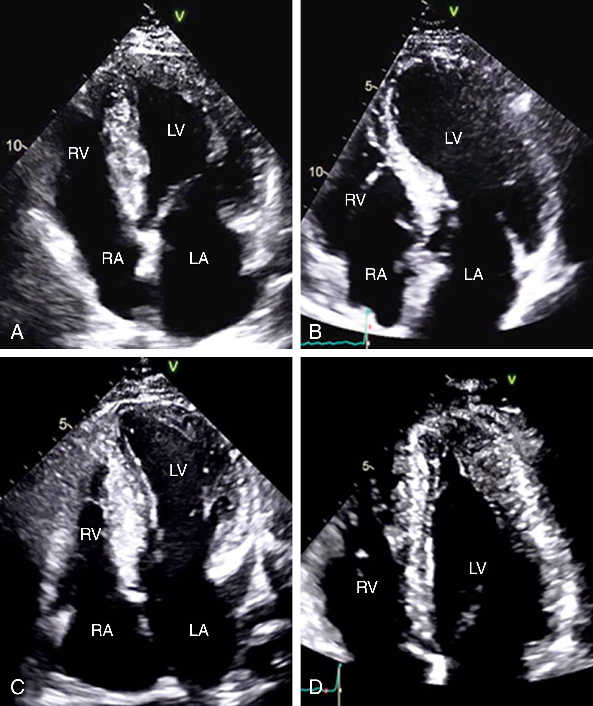 Figure 58.2, Hypertrophic cardiomyopathy morphologies in transthoracic echocardiography. Typical echocardiographic appearances of different hypertrophic cardiomyopathy morphologies including a neutral septum ( A ), a sigmoid septum ( B ), reverse curvature ( C ), and apical hypertrophy ( D ). LA, Left atrium; LV, left ventricle; RA, right atrium; RV, right ventricle.