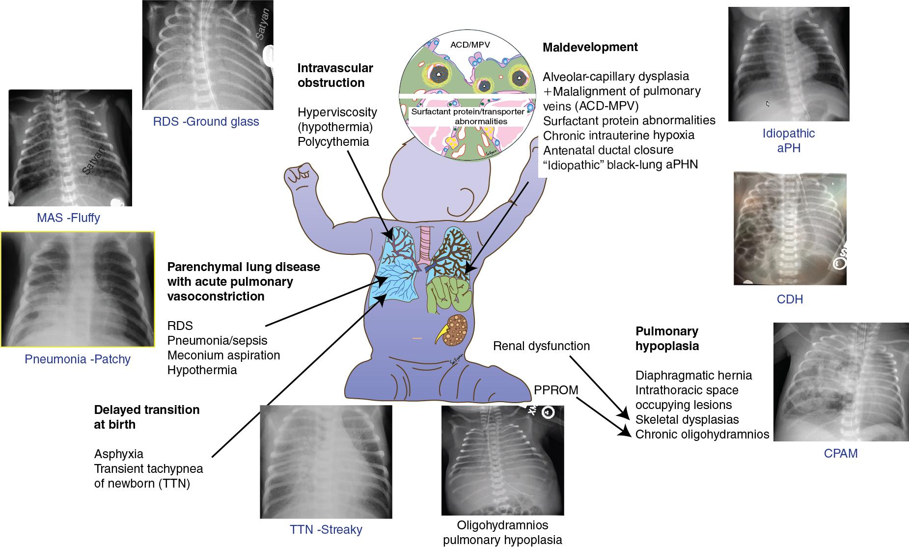 Fig. 25.1, Pathophysiological classification of acute pulmonary hypertension ( aPH ) with some representative radiological images.