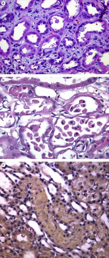 Figure 76.3, A. Morphology of acute tubular necrosis in human biopsy specimen. Proximal tubules show loss of brush border, flattening of tubular cells with denuded basement membranes, blebbing of cytoplasm (arrowhead) and vacuolization in a patient with toluene induced acute tubular necrosis. There is also evidence of extensive interstitial edema and expansion with presence of inflammatory cells (arrow). ( Slide courtesy of Dr Carrie Phillips ). B. Morphology of acute tubular necrosis in rat kidney specimen subjected to 60 minutes of hypoperfusion. Areas of detachment of cell and intact cells within the tubular lumen. C. Cellular cast within the tubular lumen.