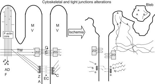 Figure 76.4, Cytoskeletal and tight junctions alterations in AKI. Ischemic insult to a proximal tubule cell disrupts actin cytoskeleton and junctional complexes. The orderly arrangement of the actin microfilaments extends from terminal web (TW) into microvilli (MV) as well as interacting with tight junction proteins zonula adherens (ZO), and adherens junction proteins zonula adherens (ZA). Occludin (OC) is transmembrance integral protein of the tight junction forming a multiprotein complex with ZO, controlling paracellular permeability. Severe ATP depletion results in occludin translocating to the cytoplasm, compromising adhesion and permeability. Similarly adherens junction proteins such E-cadherin (EC) and catenins (C) that interact with actin and other junctional components are compromised. ADF or cofilin is activated with ischemia that translocates and gets recruited to apical microvilli and binds to F-actin structures, resulting in severing and depolymerization of F-actin. This leads to subsequent apical membrane disruption and bleb formation.