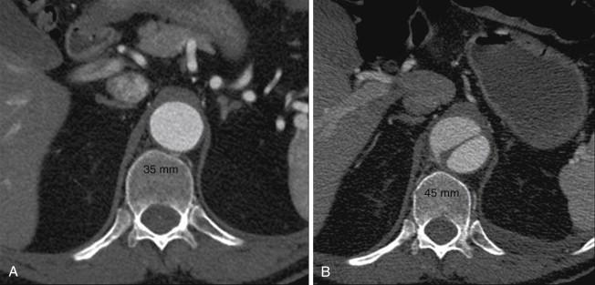 FIGURE 1, Computed tomography (CT) scans at the T11 level. A, CT obtained 16 months before presentation to the emergency department. B, CT upon presentation to the emergency department with a 5-day history of mid back and left flank pain. This scan shows acute type B aortic dissection in which total aortic diameter has acutely grown from 35 to 45 mm in diameter. The entry tear was a 2.0-cm longitudinal slit at the T10 level.