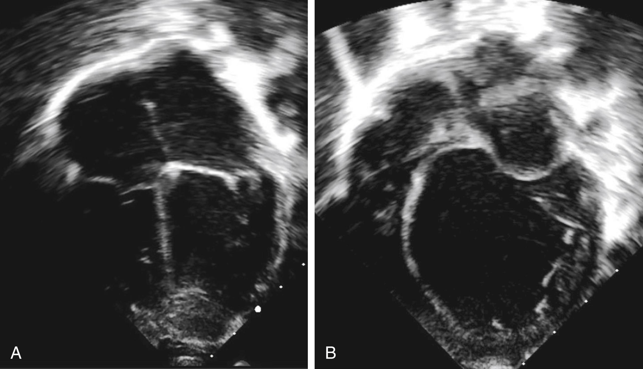 Fig. 153.3, Echocardiographic features of dilated cardiomyopathy. From a classic apical four-chamber view, 2-D echocardiography shows on the left (A), a normal triangular-shaped left ventricular chamber. On the right (B), echocardiography displays an enlarged and globular-shaped left ventricle with relative wall thinning to the chamber diameter, making the diagnosis of dilated cardiomyopathy.