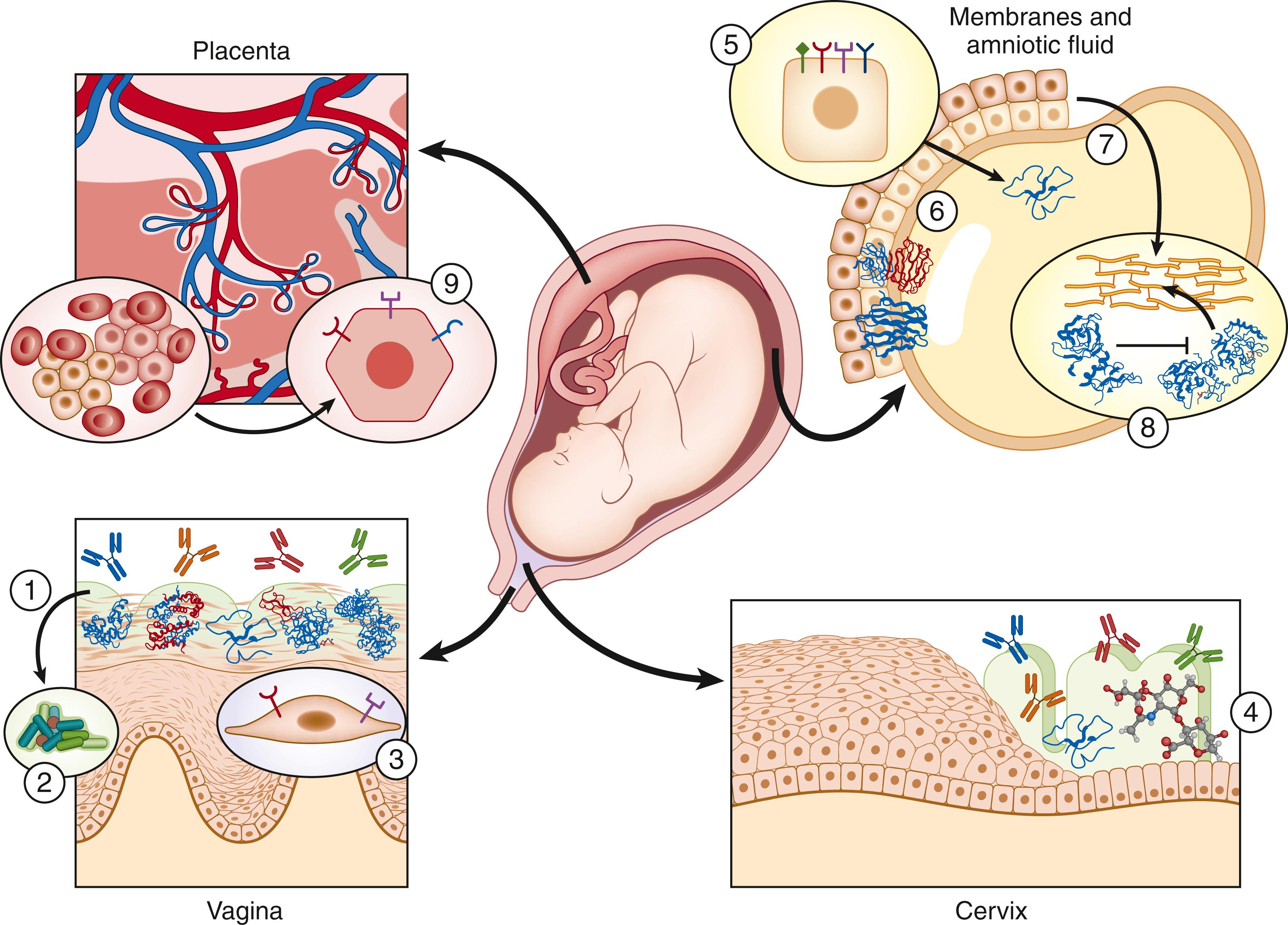 Fig. 172.1, The fetus has multiple anatomic and immune-mediated protections against infection. The vaginal mucosa (1) is rich in secreted IgA and multiple antimicrobial proteins and peptides including (from left to right) lysozyme, calprotectin, defensins, secretory leukocyte protease inhibitor, and lactoferrin. The vaginal microbiome (2) normally exerts a physiologic homeostatic role that helps to protect against dysbiosis and infection. The vaginal epithelial cells (3) express Toll-like receptors (TLRs) that, when stimulated, can activate innate immune factors to clear pathogenic organisms. The cervical mucous plug (4) is also enriched with protective immunoglobulins and defensins. Hyaluronan in the cervix contributes to a flexible barrier against ascending infection. The chorioamniotic membranes are composed of juxtaposed epithelia of maternal and fetal origins that express TLR-2, -4, -5, and -6 (5) and galectin-1 and -3 (6), both of which modulate fetal innate immunity. Secreted defensins (7) contribute to the antimicrobial properties of amniotic fluid. The physical barrier of the extracellular matrix of the membranes is continuously remodeled throughout pregnancy by matrix-metalloproteinases, whose activity is regulated by tissue inhibitors of metalloproteinase (8). In the placenta, where trophoblastic proximity to maternal cells and blood create potential for hematogenous or intercellular vertical transmission, trophoblastic TLR expression serves a protective function (9).