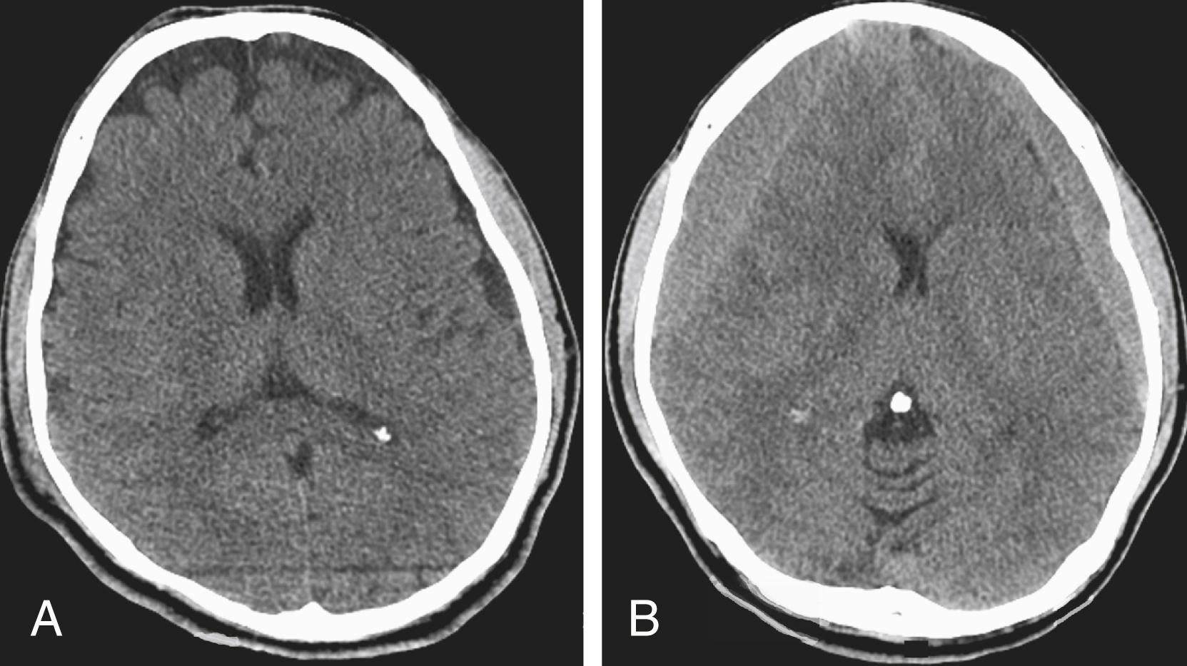 Figure 46.3, CT scans in a 27-year-old male patient who sustained a closed head injury after being struck by a train.