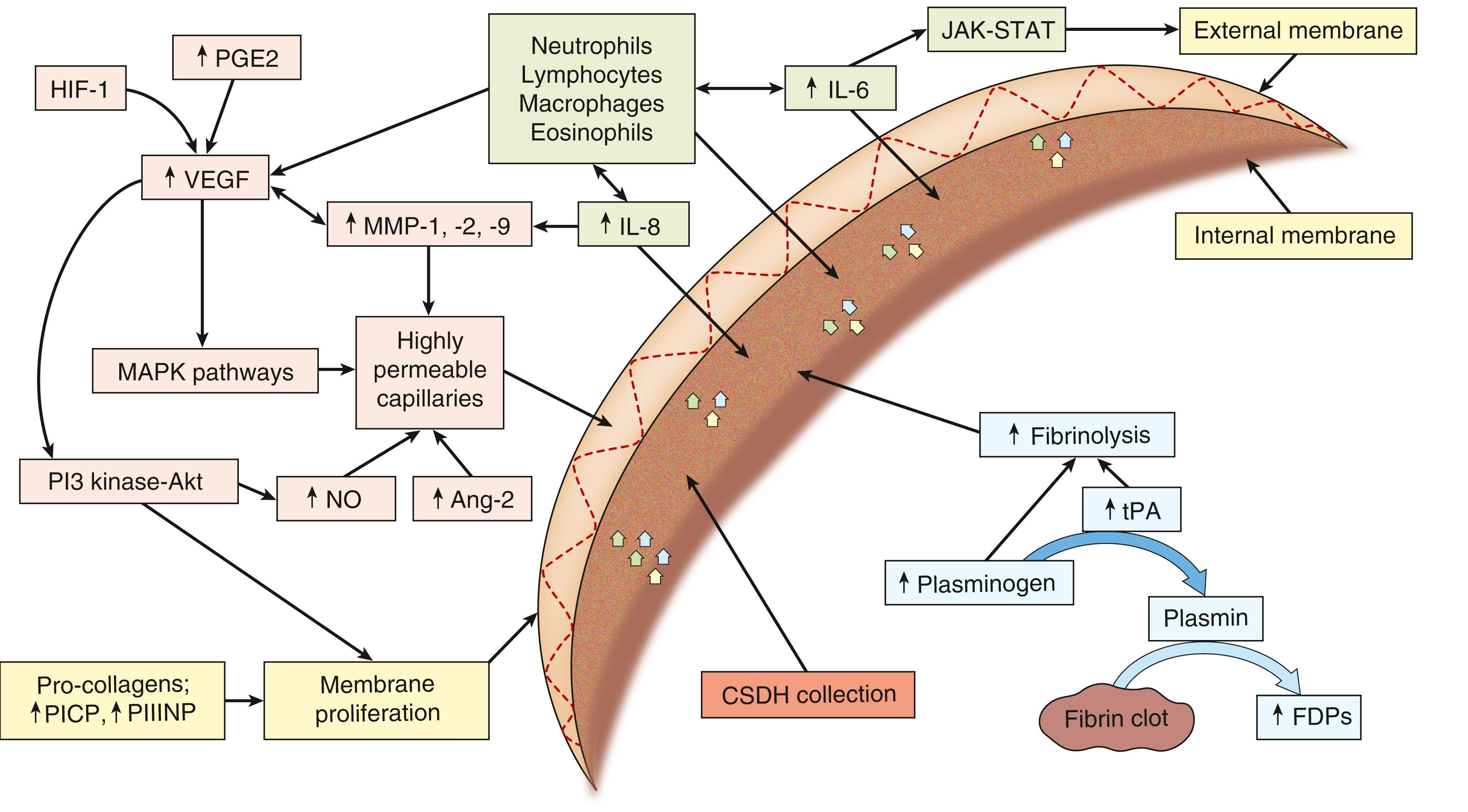 Figure 46.4, Diagram of the pathogenesis and molecules important in the formation of chronic subdural hematoma (CSDH).