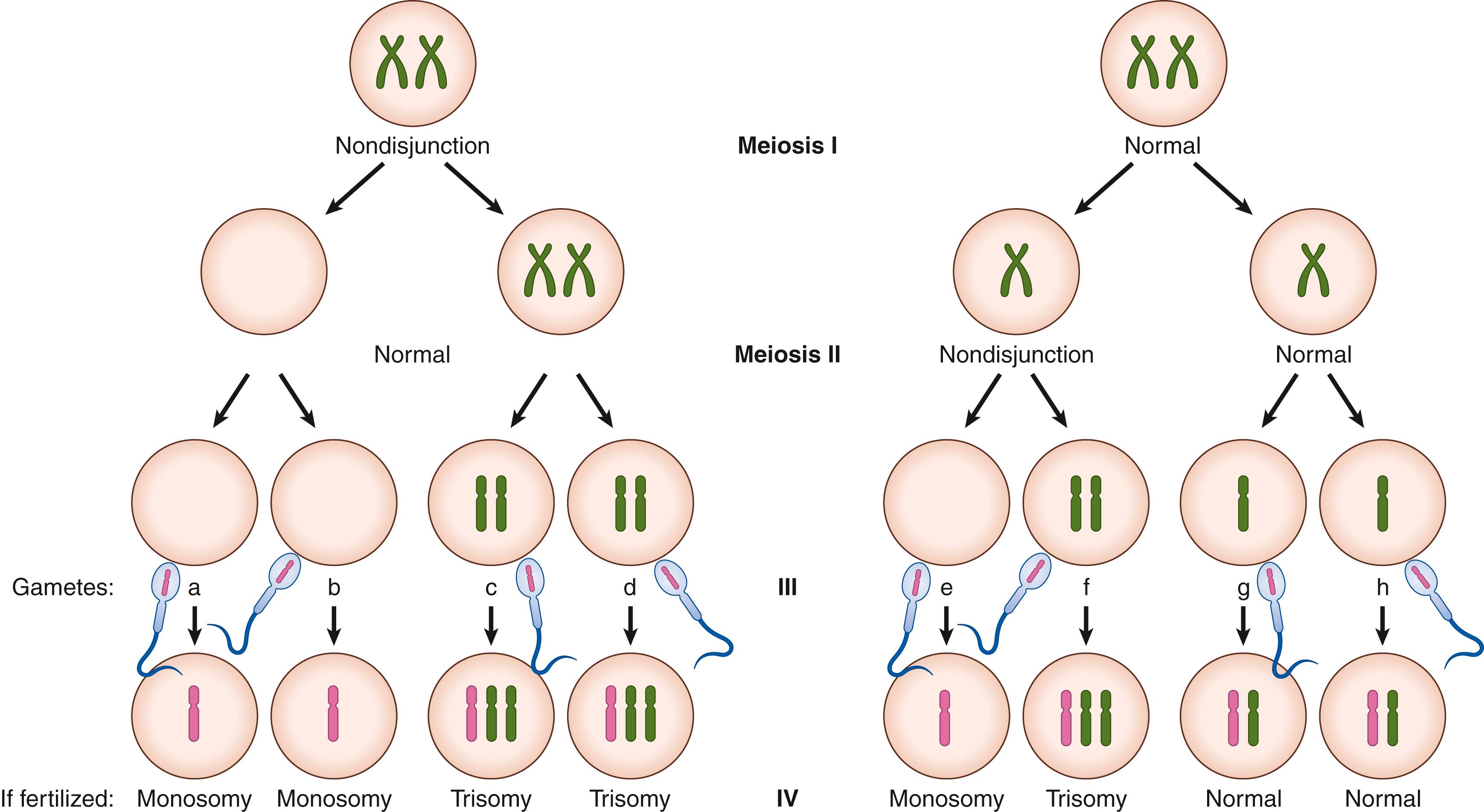 Fig. 173.2, Meiosis involves two cell divisions to create haploid gametes with one copy of each chromosome. Nondisjunction at the first (meiosis I) or second (meiosis II) cell division result in aneuploidy.