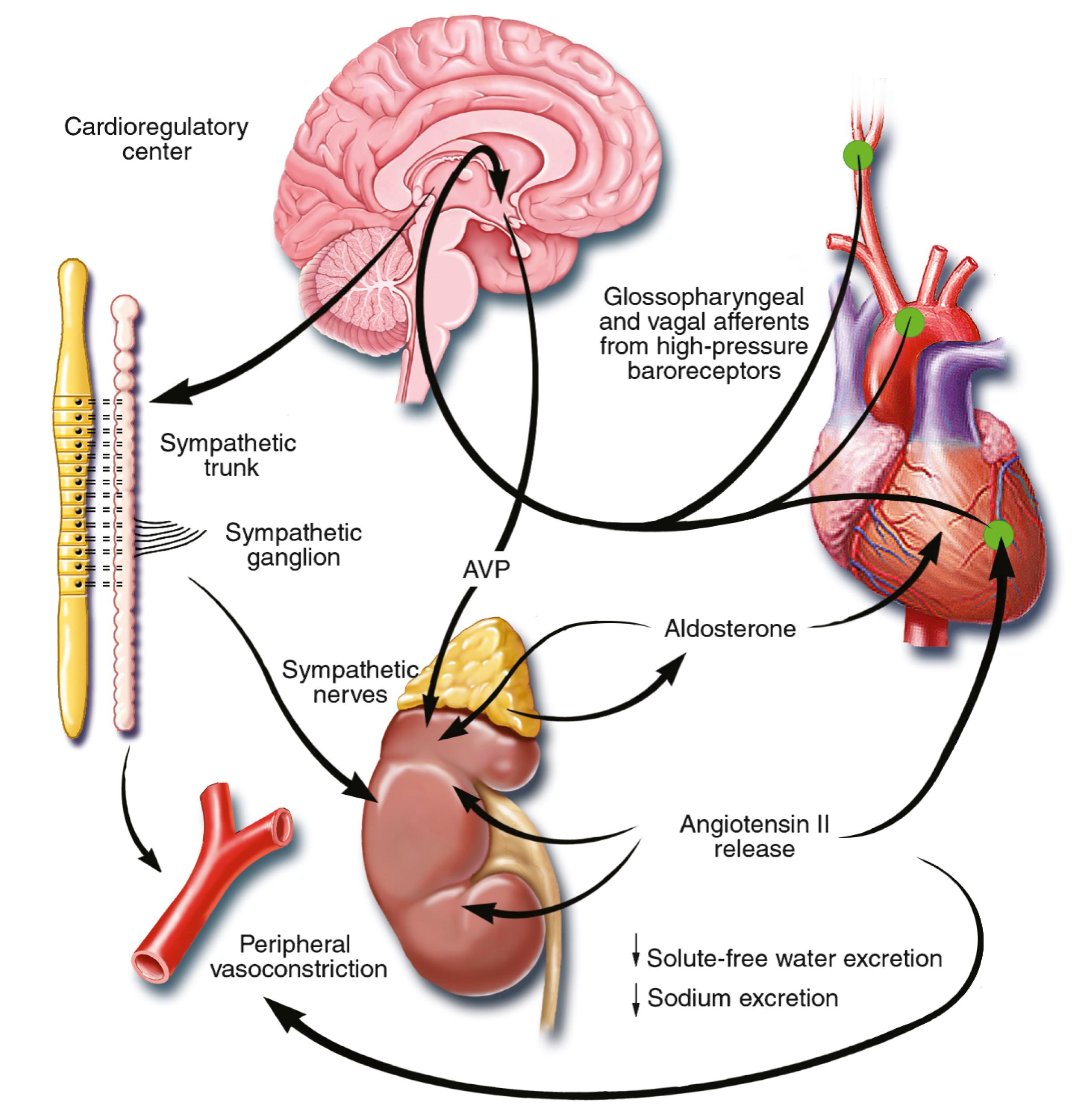 FIGURE 47.5, Unloading of high-pressure baroceptors ( green circles ) in the left ventricle, carotid sinus, and aortic arch generates afferent signals that stimulate cardioregulatory centers in the brain, resulting in the activation of efferent pathways in the sympathetic nervous system. The sympathetic nervous system (SNS) appears to be the primary integrator of the neurohumoral vasoconstrictor response to arterial underfilling. Activation of renal sympathetic nerves stimulates the release of arginine vasopressin ( AVP ). Sympathetic activation also causes peripheral and renal vasoconstriction, as does angiotensin II. Angiotensin II constricts blood vessels and stimulates the release of aldosterone from the adrenal gland, and it also increases tubular sodium reabsorption and causes remodeling of cardiac myocytes. Aldosterone also may have direct cardiac effects, in addition to increasing the reabsorption of sodium and the secretion of potassium (K + ) and hydrogen (H +) ions in the collecting duct. The black arrows designate circulating hormones.