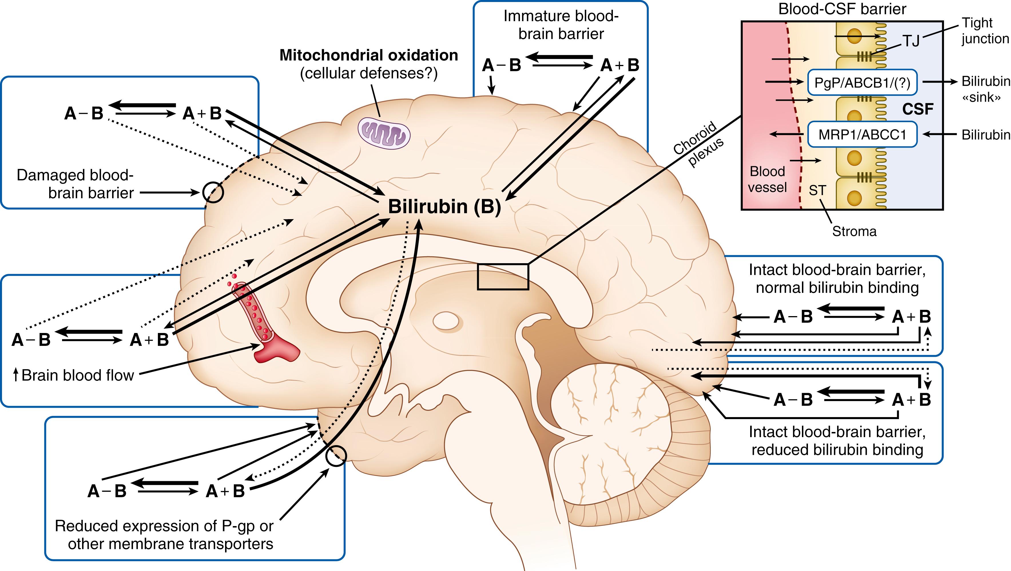 Fig. 163.3, Factors that modulate the bilirubin-brain equilibrium. A number of factors can modulate bilirubin uptake into and clearance from brain. These include the avidity of bilirubin binding to serum albumin, the presence of competitors for the albumin binding site, immaturity or other factors that may affect blood-brain permeability, the presence and activity or expression of membrane pumps in the blood-brain barrier, and brain blood flow. A, Albumin; A-B, albumin-bound bilirubin; B, (unbound) bilirubin; BV , blood vessel; CSF, cerebrospinal fluid; MRP1, multidrug resistance–associated protein 1 (also referred to as ATP binding cassette subfamily C member 1 [ABCC1); P-gp , phosphoglycoprotein (also referred to as multidrug resistance protein 1 [MDR1] or ATP-binding cassette subfamily B member 1 [ABCB1]); ST, stroma; TJ, tight junction.