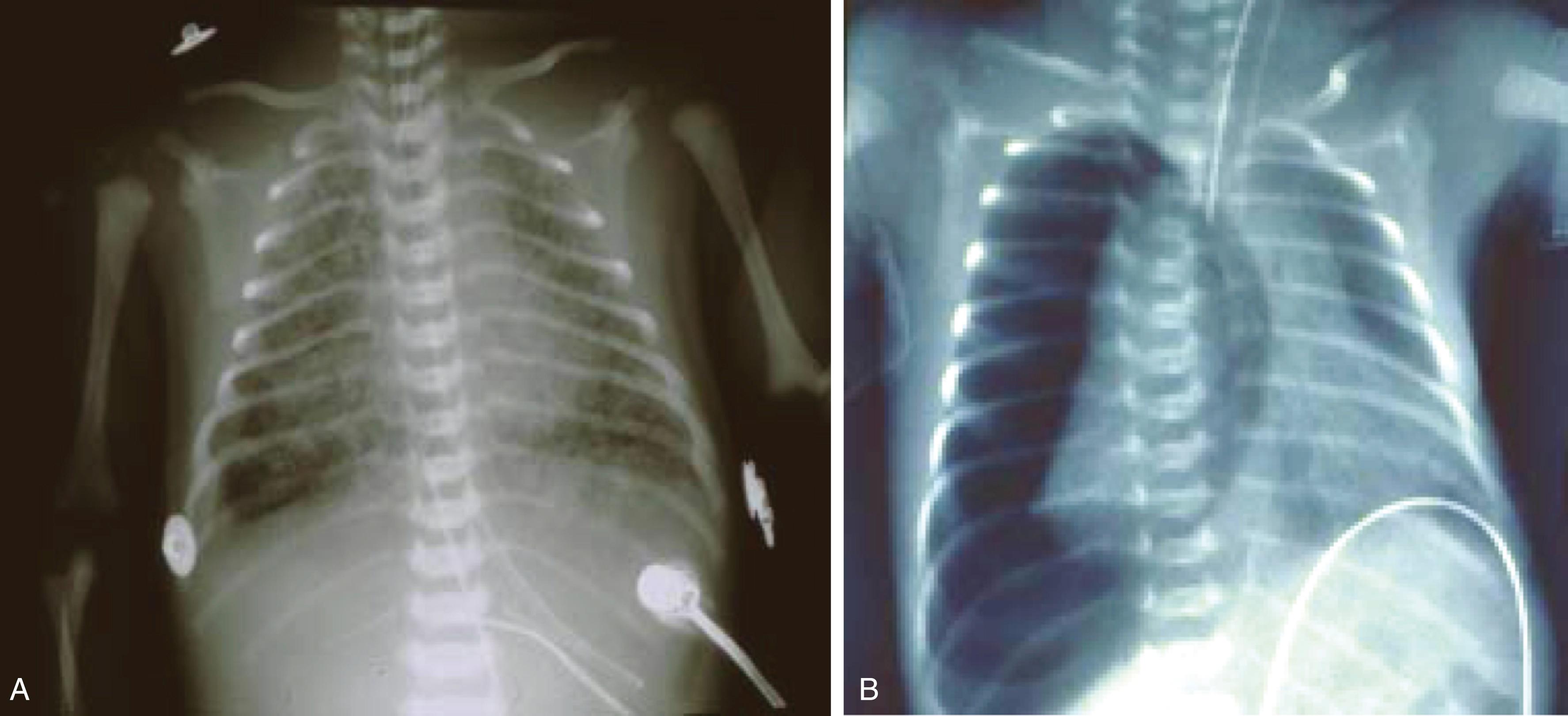 Fig. 158.1, (A) Chest radiograph demonstrating meconium aspiration syndrome with bilateral patchy infiltrates and hyperinflation at the right base. (B) Interval development of a tension pneumothorax.
