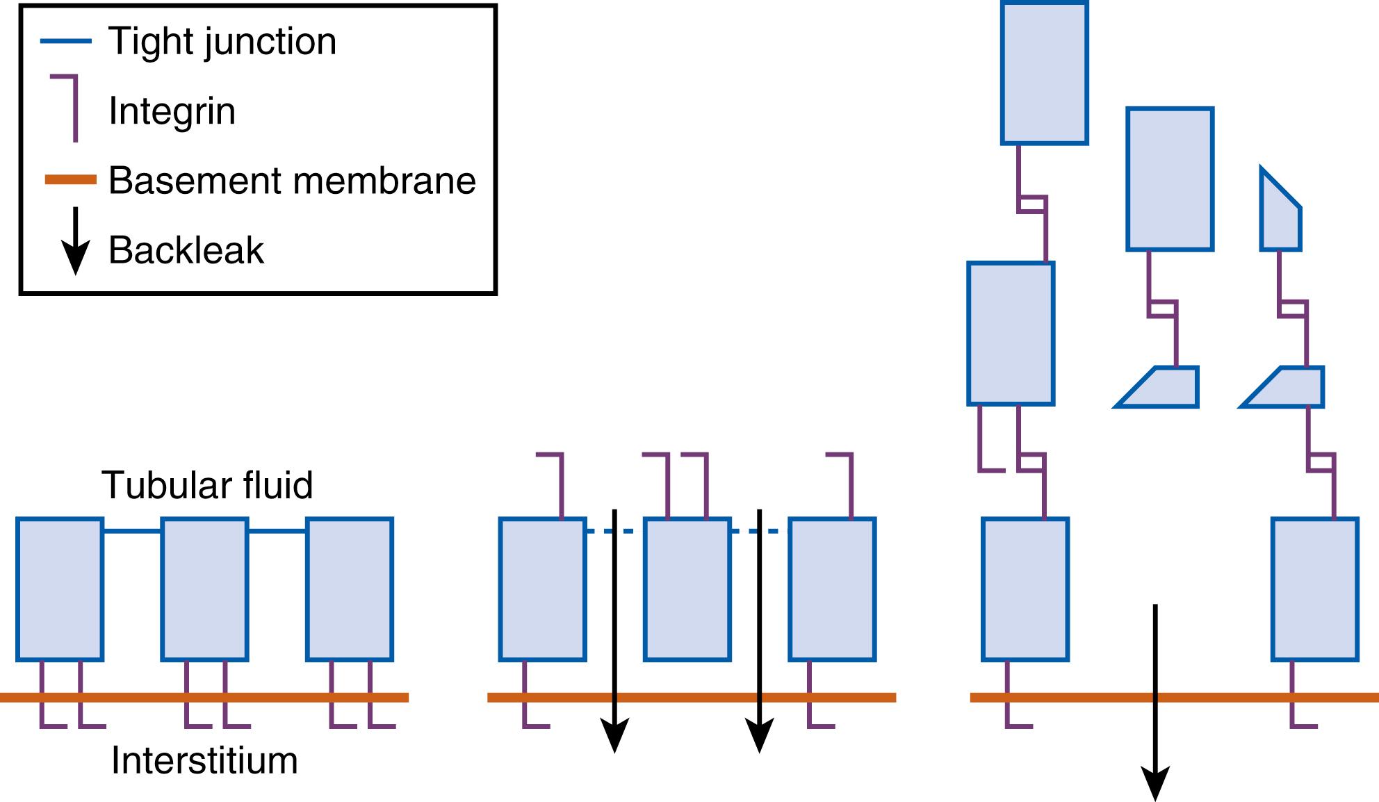 Fig. 164.3, The role of intratubular obstruction and back-leak in acute kidney injury. Left, Normal tubular cells linked by tight junctions into an epithelial sheet that forms a selective barrier between the tubular fluid compartment and the interstitium. The tight junction regulates cell polarity, segregating molecules such as the integrins to the basal plasma membrane, forming the adhesive anchorage of the cell basement membrane junction. Middle, Ischemia-induced tight junction dysfunction leads to a loss of barrier function contributing to the loss of polarity and integrin migration to the apical surface, as well as leakage of glomerular filtrate back into the interstitium. Right, Loss of basal anchorage molecules allows cells or cell fragments to exfoliate into the tubular lumen and adhere and aggregate with other exfoliated cells or fragments, contributing to an increase in tubular pressure proximal to the obstruction. Tubular obstruction will oppose glomerular filtration, as well as accelerate back-leak of tubular fluid across the denuded basement membrane.