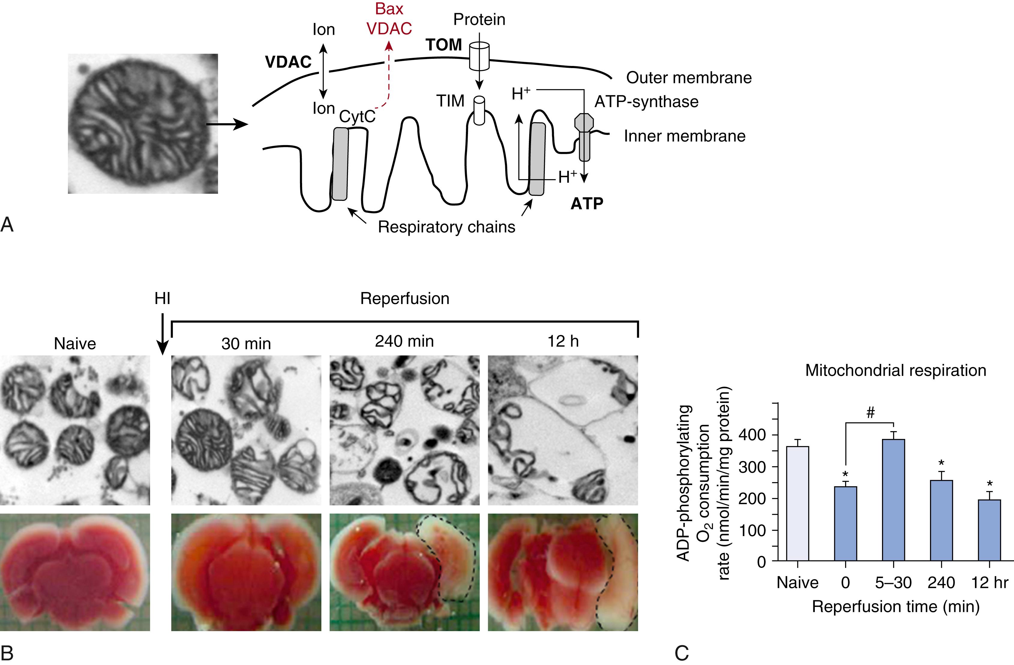 Fig. 167.3, Schema of mitochondrial intermembrane space with systems providing ion exchange ( VDAC , voltage dependent anion channel), protein import (translocator of the outer and inner membrane, TOM/TIM ), matrix located structures for oxidative phosphorylation. Pathologic Bax/VDAC interaction driven permeabilization of the outer membrane is colored in red (A). Electron microscopy of mitochondria isolated from the injured hemisphere with outlined infarcts during reperfusion (B) and adenosine-diphosphate (ADP) -phosphorylating respiration rates in mitochondria isolated from the injured hemisphere (C).