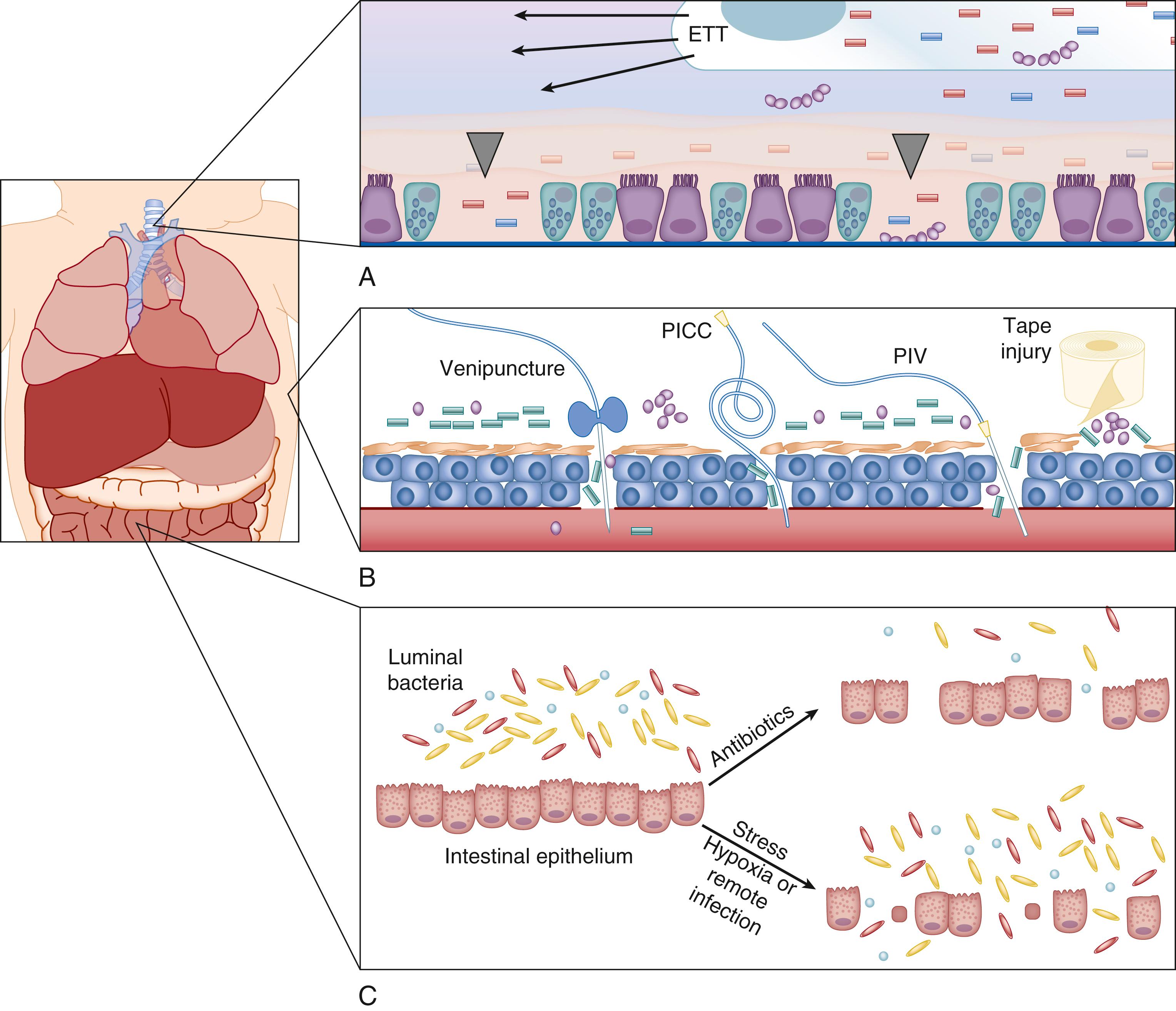 Fig. 151.2, Physical barriers. (A) Respiratory mucosa : A foreign body (ETT) and/or positive pressure can irritate and injure the respiratory epithelium (ciliated cells, gray arrowheads denote denuded areas). Increased goblet cells (blue cells with inclusions) with decreased mucociliary clearance of airway further increases the likelihood of infection (bacteria represented by purple spherical chains and blue/pink rods). (B) Skin : Disruptions associated with trauma (venipuncture or heelstick), PICC, PIV, or tape-related abrasions compromise the skin barrier (bacteria represented by clusters of purple spheres and green rods). (C) Gastrointestinal mucosa : Luminal bacteria (microbiota) are a valuable component of the mucosal barrier. The interaction between intestinal bacteria and intestinal epithelium is necessary for homeostasis and normal function of repair mechanisms. Disruption of this interaction, through the use of antibiotics or via stress to the organism (e.g., hypoxia or remote infection such as sepsis or pneumonia) results in loss of homeostasis and degradation of the intestinal boundaries with subsequent microbial translocation. ETT, Endotracheal tube; PICC , peripherally inserted central catheter; PIV , peripheral intravenous (line).