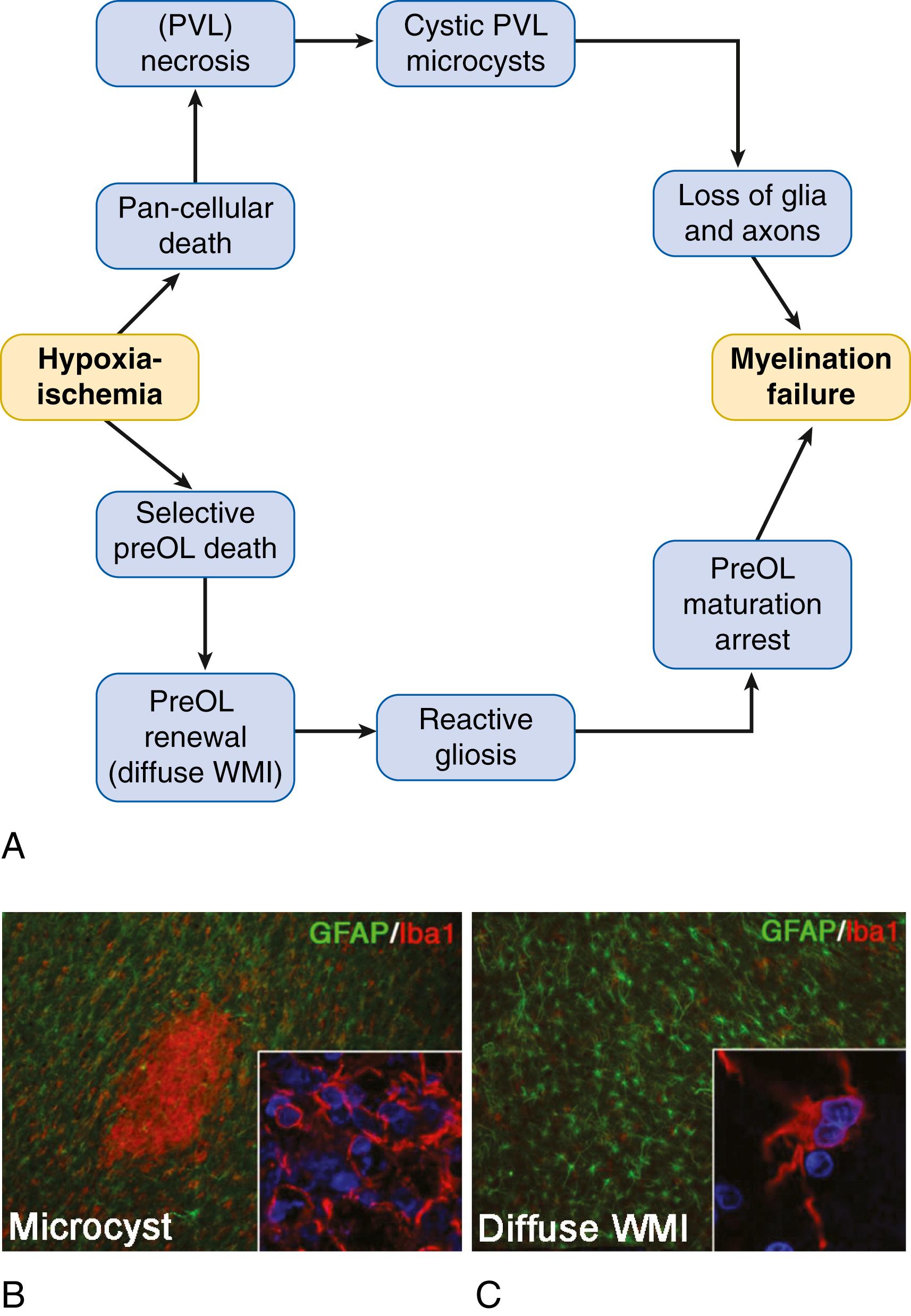 Fig. 132.1, (A) Distinctly different pathogenetic mechanisms mediate abnormal myelination in necrotic lesions (periventricular leukomalacia [PVL] ; upper pathway) compared with lesions with diffuse white matter injury (WMI; lower pathway) . Hypoxia-ischemia (H-I) is illustrated as one potential trigger for WMI. More severe H-I triggers white matter necrosis (upper pathway) that depletes the white matter of all cells. Severe necrosis results in cystic PVL, whereas milder necrosis results in microcysts. Milder H-I (lower pathway) selectively triggers death of premyelinating oligodendrocyte (preOLs) that are rapidly regenerated but blocked from maturation by astrocytes-derived factors. Note that the lower pathway is the dominant one in most contemporary preterm neonates, whereas the minor upper pathway reflects the declining burden of white matter necrosis that has accompanied advances in neonatal intensive care. (B) A typical microscopic necrotic lesion containing reactive microglia and macrophages (red cells and inset) and rare astrocytes (green cells) . Nuclei are blue . (C) Diffuse WMI is notable for reactive astrocytes (green cells) and a lesser population of microglia/macrophages (red cells) .