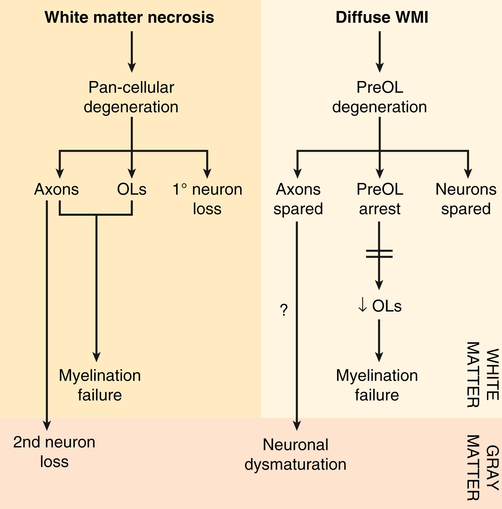 Fig. 132.2, In the preterm premyelinated white matter, the cellular mechanisms of cerebral white matter injury (WMI) and gray matter injury are distinct for necrotic and diffuse WMI. White matter necrosis (cystic periventricular leukomalacia [PVL] /microcysts; left panel ) is characterized by death of all cells. Degeneration of axons and/or oligodendrocytes (OLs) both can lead to myelination failure. Degeneration of axons can lead to secondary neuronal loss in cerebral gray matter. Diffuse WMI (right panel) involves selective death of premyelinating oligodendrocytes (preOLs) with sparing of axons and neurons. Myelination failure is related to preOLs that fail to differentiate to OLs that make myelin.