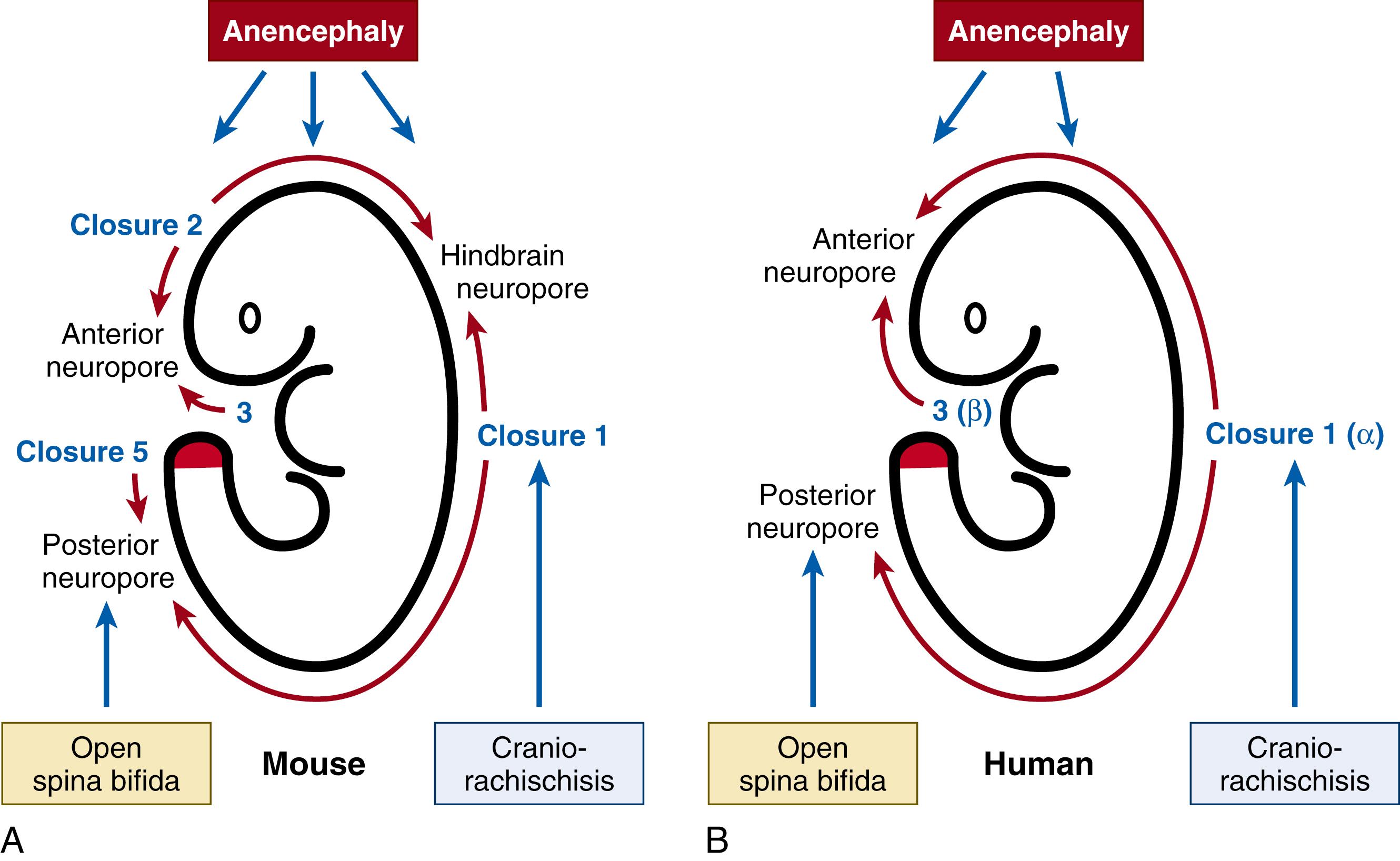 Fig. 169.1, Schematic of neural tube closure and the origin of neural tube defects (NTDs) in mouse and human embryos. (A) In mice, closure initiates sequentially at four separate sites: Closures 1, 2, 3, and 5 . Note that Closure 4 was postulated in the hindbrain, 11 but this not been confirmed. Zippering occurs from the initiation sites, to complete closure at the three neuropores: anterior, hindbrain, and posterior. From Closure 1 , zippering progresses in a rostral direction into the hindbrain and simultaneously in a caudal direction along the spinal region. From Closure 2 , bi-directional zippering occurs rostrally into the forebrain and caudally into the midbrain and then hindbrain. From Closure 3 , unidirectional (caudal) zippering occurs through the forebrain. (B) In humans, two initiation sites occur: site α ( Closure 1 equivalent) and site β ( Closure 3 equivalent). Zippering from site α progresses in a rostral direction, into the hindbrain and then midbrain, and in a caudal direction along the spine. From site β, closure occurs in a caudal direction through the forebrain. Closure is completed at two neuropores: anterior (rostral) and posterior (caudal). In both mice and humans, secondary neurulation occurs in the tail-bud (caudal eminence) to elongate the neural tube caudal to the upper sacral level, where primary neurulation finishes. The neurulation events whose failure gives rise to the main NTD types are indicated.