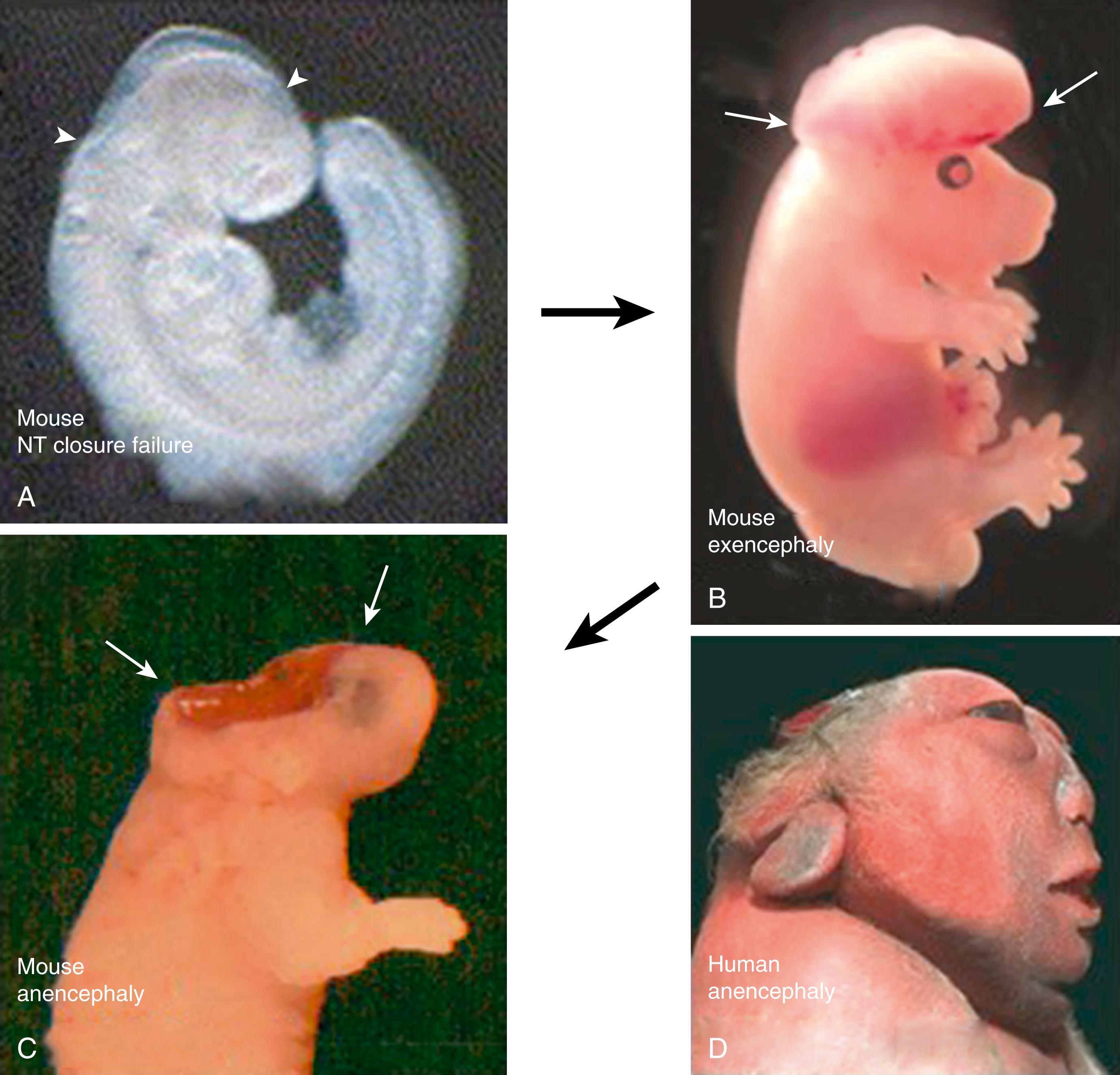 Fig. 169.2, Embryonic and fetal development of anencephaly. (A–C) Events in the mouse beginning with failed closure of the cranial neural tube (NT) at E9.5 (between arrowheads in A), then eversion of the initially healthy neural tissue as exencephaly at E13.5 (between arrows in B) and finally degeneration of the exposed neural tissue resulting in anencephaly in the newborn (between arrows in C). (D) Human anencephaly viewed from the right side in a stillborn fetus.