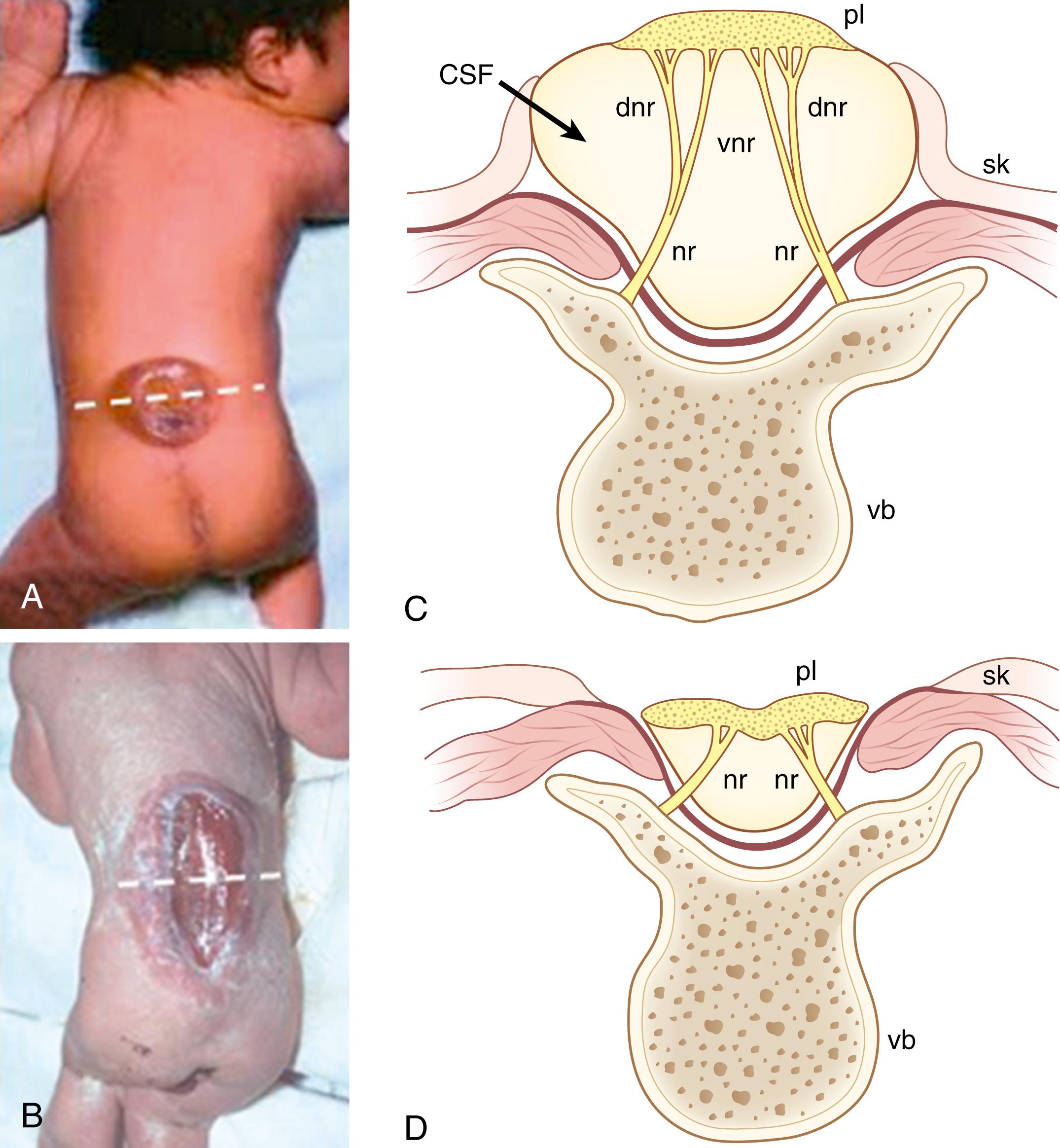 Fig. 169.3, The two main forms of open spina bifida. (A) Myelomeningocele (spina bifida cystica), showing the cystic lesion on the back of the newborn baby. (B) Myelocele, showing an open neural tube on the surface of the newborn baby’s back with no cystic lesion. (C and D) Schematic cross-sections through myelomeningocele (A) and myelocele (B) lesions, at levels indicated by dashed lines in A and B. Note the differing relationships of the open spinal cord ( pl , placode) to the associated tissues, owing to the presence or absence of the cerebrospinal fluid (CSF) -containing sac. dnr , Dorsal nerve roots; nr , nerve roots; sk , skin; vb , vertebral body; vnr , ventral nerve roots.