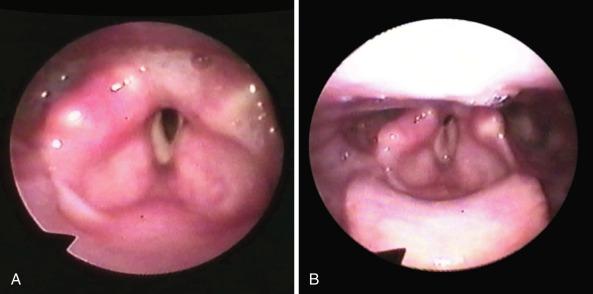 Fig. 42.1, Bilateral laryngeal paralysis resulting from a thyroidectomy for cancer involving both recurrent laryngeal nerves. A, Immediately after surgery: vocal folds are partially abducted. B, Six months later: vocal folds have shifted toward the midline.