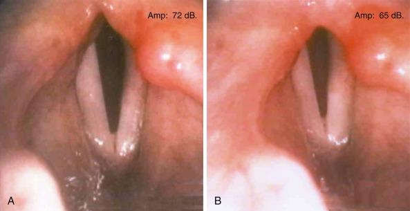 Fig. 42.2, Paradoxical motion of the vocal folds in bilateral laryngeal paralysis after total thyroidectomy. A, Quiet breathing. B, Deep breathing.