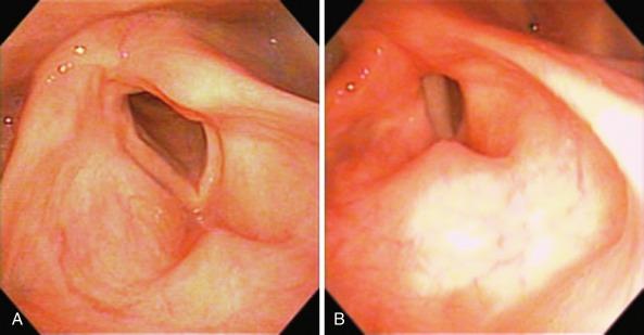 Fig. 42.3, Limitation of glottic closure in flaccid laryngeal paralysis. Note how the vocal process is rotated laterally so that the body of the arytenoid precludes closure.