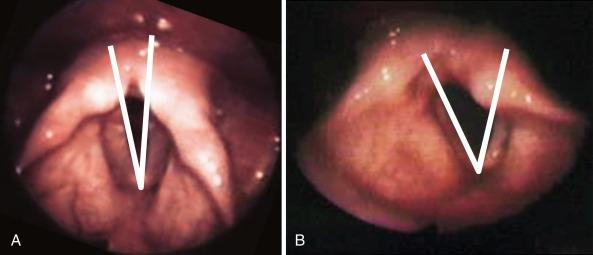 Fig. 42.4, Anterior glottic angle, measured during deep inspiration, is defined by lines connecting the anterior commissure with each vocal process. A, Paramedian vocal fold position. B, Lateral, or “cadaveric,” vocal fold position.