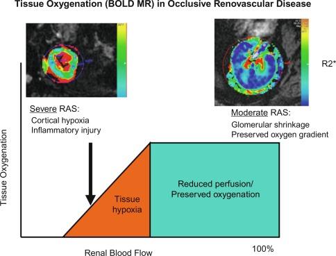 Fig. 22.2, Adaptation of Tissue Oxygenation Within the Kidney to Renovascular Disease.