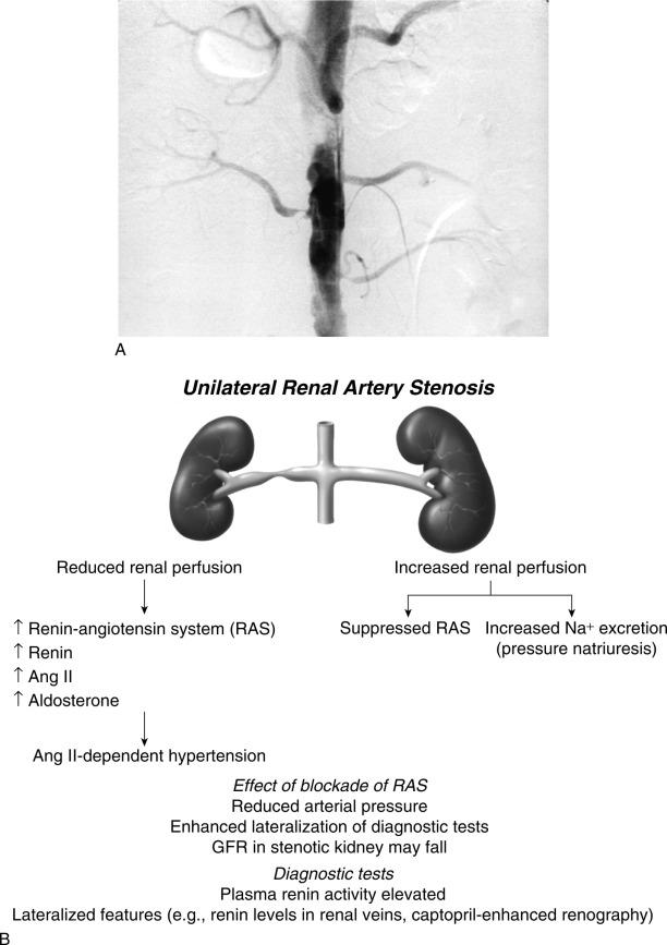 Fig. 22.6, (A) Angiogram of unilateral renal arterial stenosis with well-preserved vascular supply to the contralateral kidney. (B ) Schematic illustrating the pathophysiology of unilateral renovascular hypertension (two-kidney, one-clip). The stenotic kidney responds to reduced perfusion with activation of the renin-angiotensin system producing widespread effects, including an increase in arterial pressure. However, elevated pressures subject the nonstenotic kidney to “pressure natriuresis,” leading to asymmetric sodium excretion, a decrease in blood pressure, and continued stimuli to the stenotic kidney. Such asymmetry is the basis for diagnostic testing, such as captopril renography and renal vein renin measurements. Ang , Angiotensin; GFR , glomerular filtration rate.