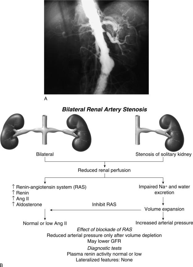 Fig. 22.7, (A) Angiogram illustrating renal artery stenosis affecting the entire renal mass, in this case a solitary functioning kidney. The contralateral kidney is occluded. (B ) Schematic illustrating the pathophysiology of renovascular hypertension in which stenosis affects the entire renal mass. In the absence of a normal contralateral kidney, sodium retention occurs and hypertension is heavily dependent upon volume mechanisms. Ang , Angiotensin; GFR , glomerular filtration rate.