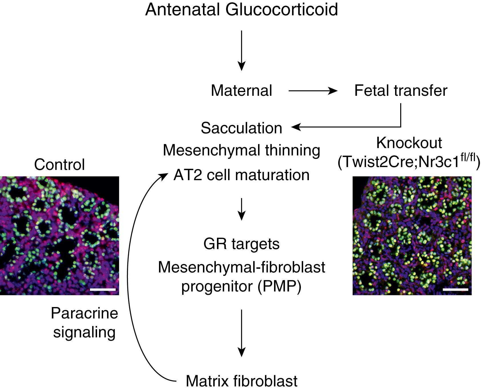 Fig. 157.4, Antenatal glucocorticoid signaling of fetal lung maturation. Based on new information from transgenic mouse models. 47 The figure illustrates that the induction of lung maturation primarily is through a newly identified mesenchymal precursor cell through a mesenchymal fibroblast to the surfactant producing Type 2 cells. Sketch based on. 47 Tissue was stained for Thyroid transcription factor-1 (TTF-1) in epithelial cells (green) , Glucocorticoid receptor (GR) in red and DAPI dye for nuclei.