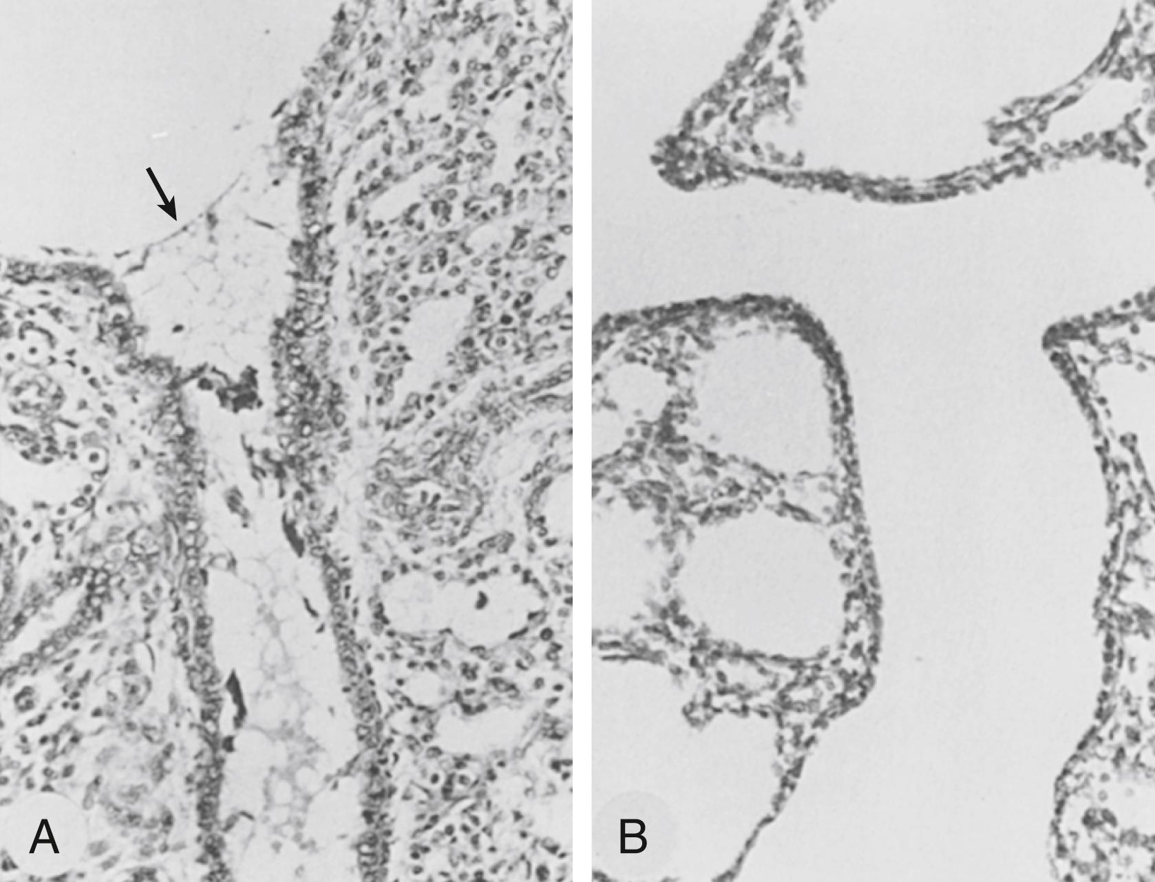 Fig. 157.7, Bronchiolar-epithelial injury in respiratory distress syndrome. (A) Lungs from preterm ventilated rabbits had fluid-filled airways with epithelial tears in the absence of surfactant treatment. Arrow indicates air fluid interface in small airway . (B) With surfactant treatments, the bronchiolar epithelium remained intact, and fluid was cleared from the airways and alveoli.