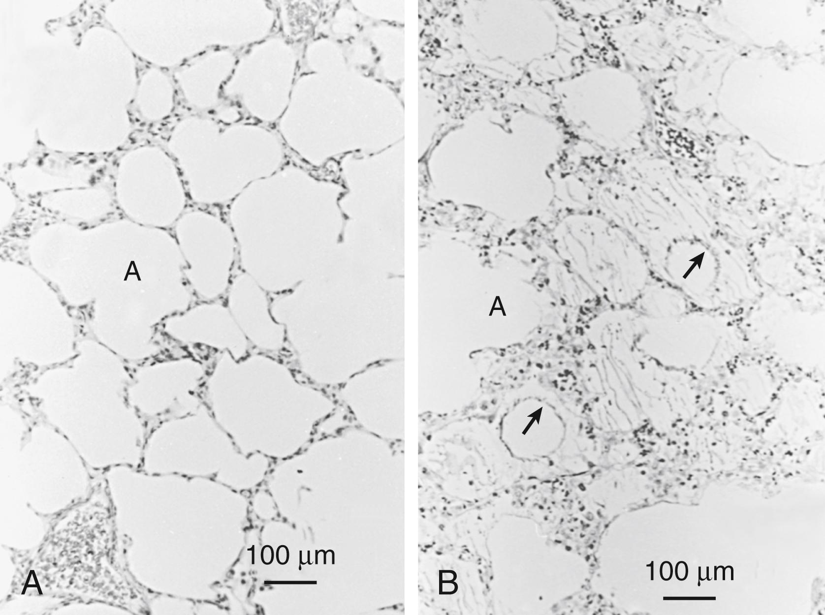 Fig. 157.8, Fluid-filled alveoli with respiratory distress syndrome (RDS). (A) Light micrograph of flash-frozen lung tissue from a preterm monkey without RDS. The alveoli and alveolar ducts (indicated by A ) are air-filled. (B) In contrast, lung tissue from a monkey with RDS has some air-filled alveoli, and other alveoli are completely or partially filled with proteinaceous material. The arrows indicate partially filled alveoli.