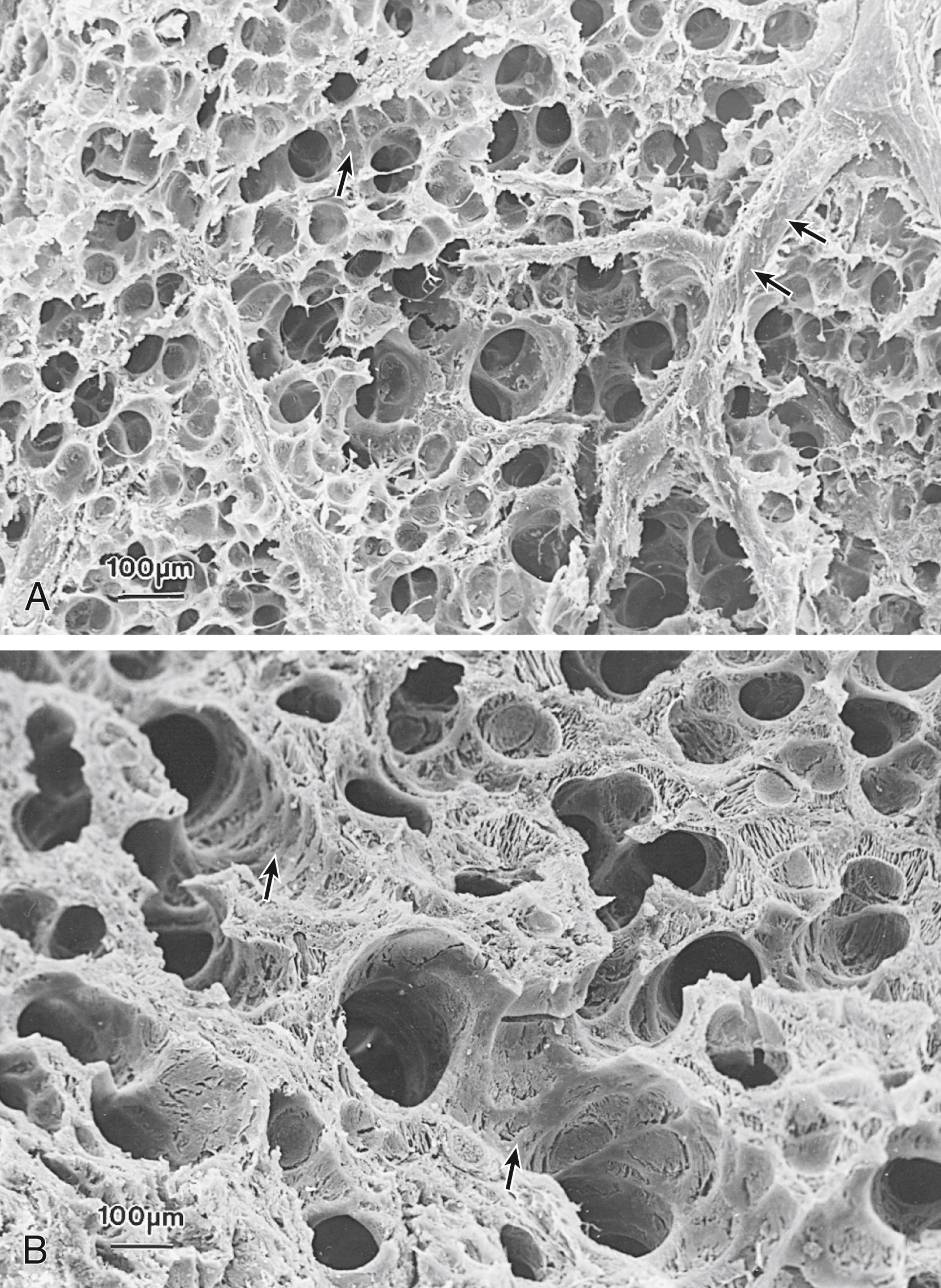 Fig. 157.9, Scanning electron micrographs from a preterm monkey without respiratory distress syndrome (RDS; A) and a preterm monkey at the same gestational age with RDS (B). The lung from the RDS animal has dilated alveolar ducts and interstitial and alveolar edema as indicated by arrow .