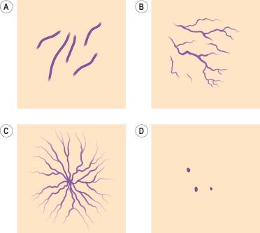 Figure 4.1, Four types of telangiectasias. A, Simple. B, Arborized. C, Spider. D, Papular.