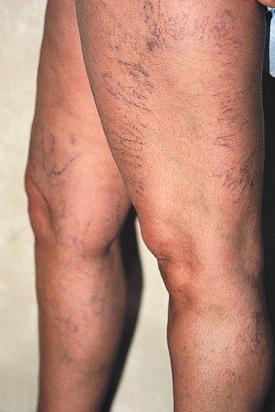 Figure 4.3, Common appearance of cartwheel or radiating telangiectasia pattern on the lateral thigh of a 42-year-old woman. Note the feeding blue reticular vein at the distal aspect of the telangiectatic pattern.