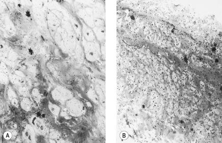 Figure 3.2, Light microscope autoradiographies of human saphenous vein strips incubated with 3 H-noradrenaline. In the control vein (right), clusters of silver grains indicative of adrenergic varicosities are seen throughout the media. Smooth muscle cells exhibit a high density of silver grains. In the varicose vein (left), nerve varicosities are less abundant, and smooth muscle cells are larger and have a much lower density of silver grains. Collagen is more abundant. Bars = 10 µm.