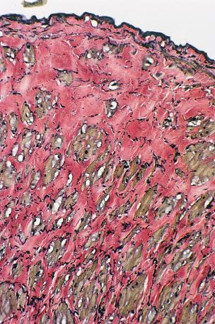 Figure 3.3, Cross-section of a tributary to the great saphenous vein in a 46-year-old man, stained with Verhoeff–van Gieson (×150). Note extensive fragmentation of elastin fibers interspersed between irregularly oriented muscle bundles with marked hypertrophy of collagen fibers. Elastic fibers stain black; collagen, red; muscle, brown–yellow.