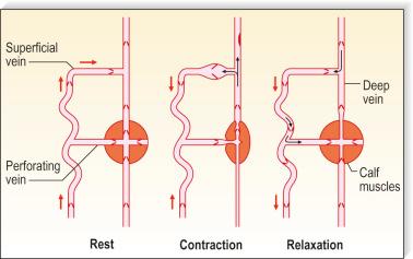 Figure 3.7, Private circulation of blood flow in primary varicose veins demonstrating a retrograde circuitous blood flow with muscle contraction and relaxation.