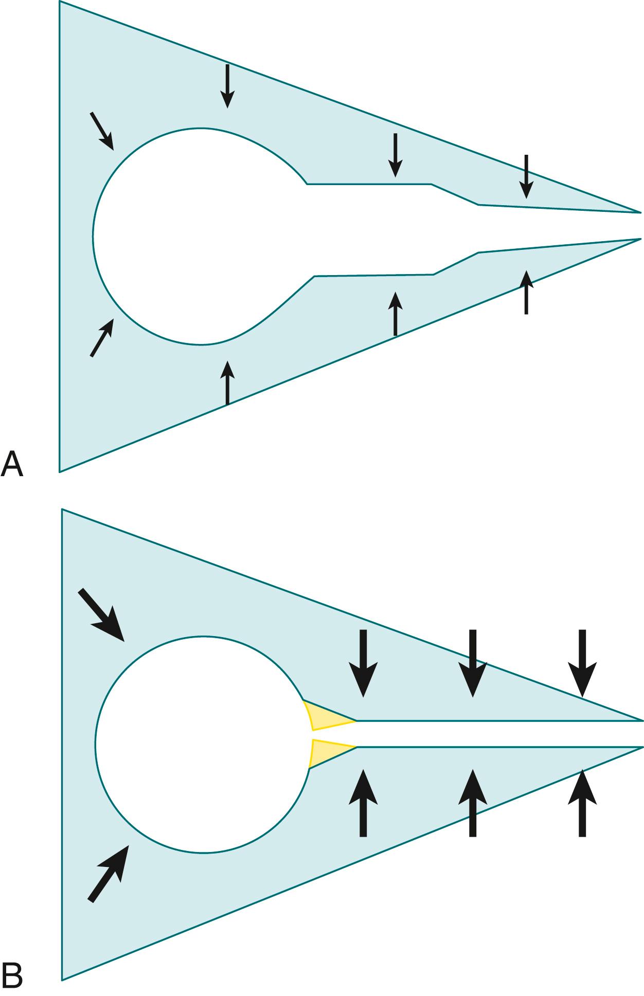 Fig. 160.3, (A) In an infant with tracheomalacia or bronchomalacia, central airway collapse occurs even when collapsing (transmural) pressure is low because of the abnormal compliance of the airway wall. (B) The central airways can appear abnormally collapsible in the presence of peripheral airway obstruction because the infant must exert higher pleural pressures (heavy arrows) to overcome the obstruction. Intraluminal pressure also falls more quickly than normal because of resistive losses, accentuating the collapsing transmural pressure across airway walls.