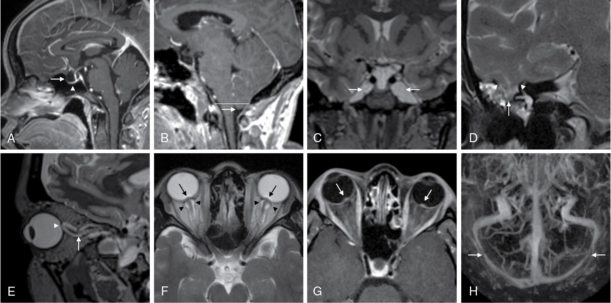 Fig. 15.1, Imaging examples of magnetic resonance (MR) imaging signs of intracranial hypertension. A, “Empty” sella turcica. Sagittal postcontrast T1-weighted image. Arrow demonstrates an expanded, cerebrospinal fluid (CSF)–filled “empty”-appearing sella turcica. Arrowhead illustrates a flattened appearance of the pituitary gland against the floor of the sella turcica. B, Cerebellar tonsillar ectopia. Sagittal postcontrast T1-weighted image. Low-lying position but normal rounded morphology of the cerebellar tonsils (arrow) 5-mm below the foramen magnum (white line). C, Enlarged Meckel’s caves. Coronal T2-weighted image. Arrows demonstrate abnormally enlarged CSF-filled Meckel’s caves bilaterally. D, Meningoencephalocele. Coronal T2-weighted image through the right temporal lobe. Arrowheads indicate margins of defects in the tegmen mastoideum transmitting CSF and a portion of the right inferior temporal lobe (arrow) . Fluid within adjacent mastoid air cells indicates associated CSF leak. E, Posterior scleral flattening and increased optic nerve tortuosity. Oblique sagittal reconstruction of volumetric T2-weighted image in the plane of the optic nerve demonstrates posterior scleral flattening (arrowhead) and increased vertical tortuosity of the intra-orbital optic nerve sheath complex (arrow). F, Optic nerve head protrusion and increased perioptic nerve CSF. Axial T2-weighted image shows protrusion of the prelaminar optic nerves (arrows) , indicating severe papilledema and distension of the optic nerve sheaths by CSF (arrowheads) bilaterally. G, Optic nerve head enhancement. Axial postcontrast T1-weighted image demonstrates enhancement of the prelaminar optic nerves bilaterally (arrows) , indicating optic disc edema. H, Transverse venous sinus stenosis. Cranio-caudal maximum intensity projection of a postcontrast MR venogram. Arrows demonstrate smooth, tapered severe stenosis of the distal transverse sinuses bilaterally.