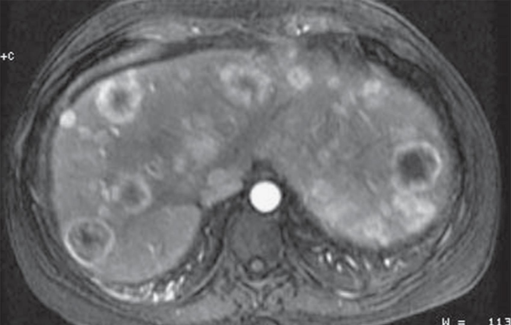 Fig. 64.1, Hematogenous metastases.