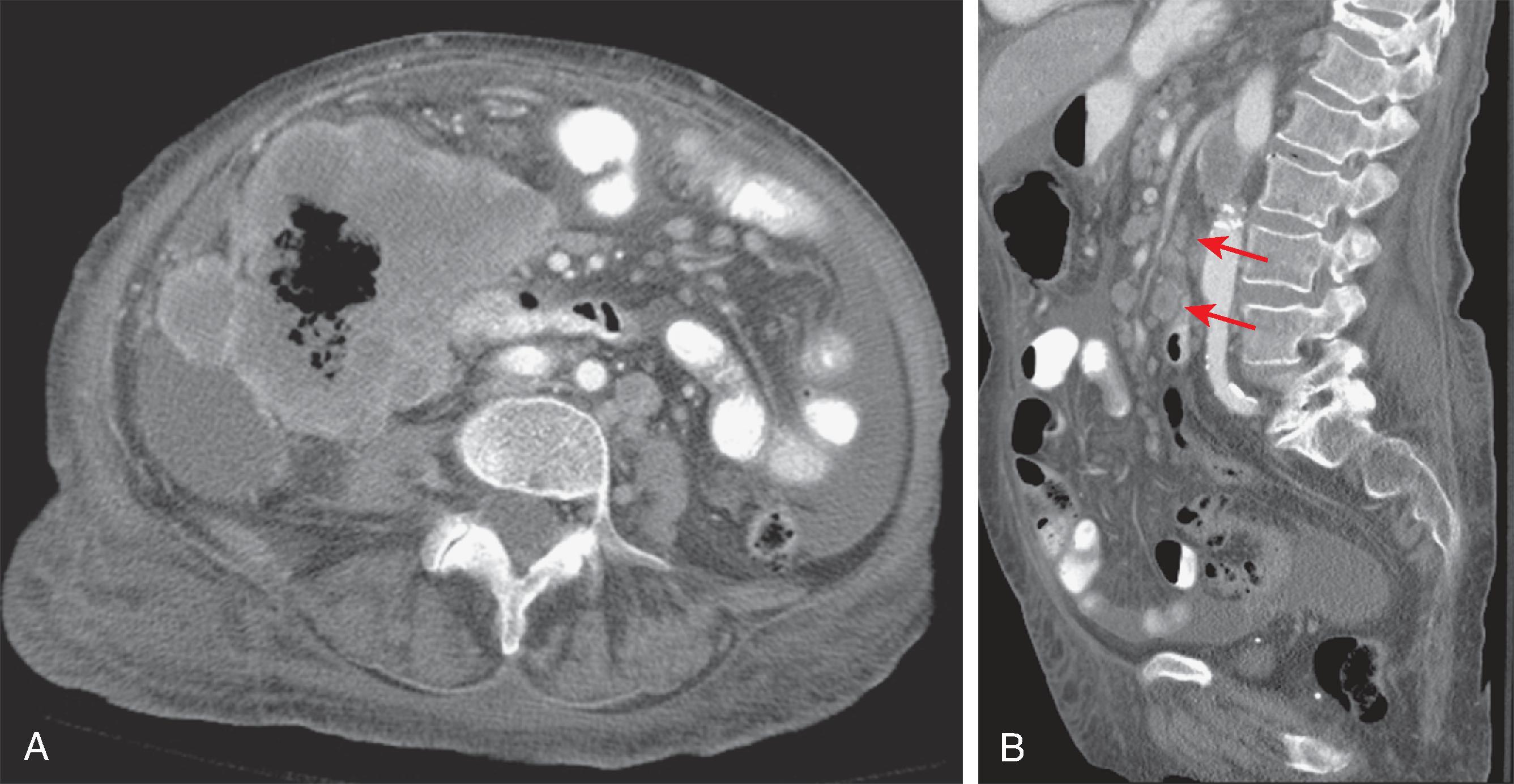 Fig. 64.2, Lymphatic metastases: computed tomography findings.