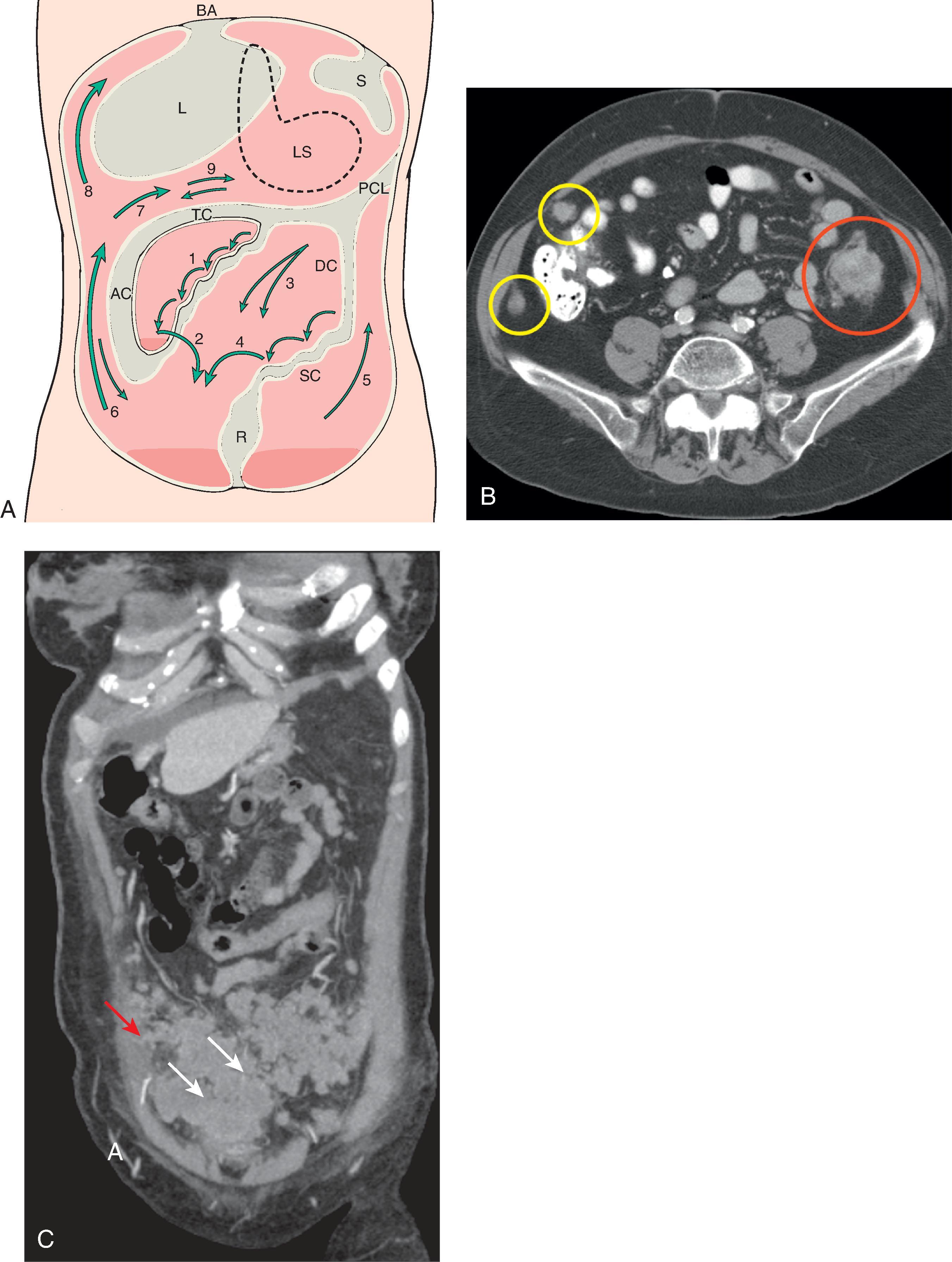 Fig. 64.3, Intraperitoneal spread of tumor: spectrum of imaging findings.