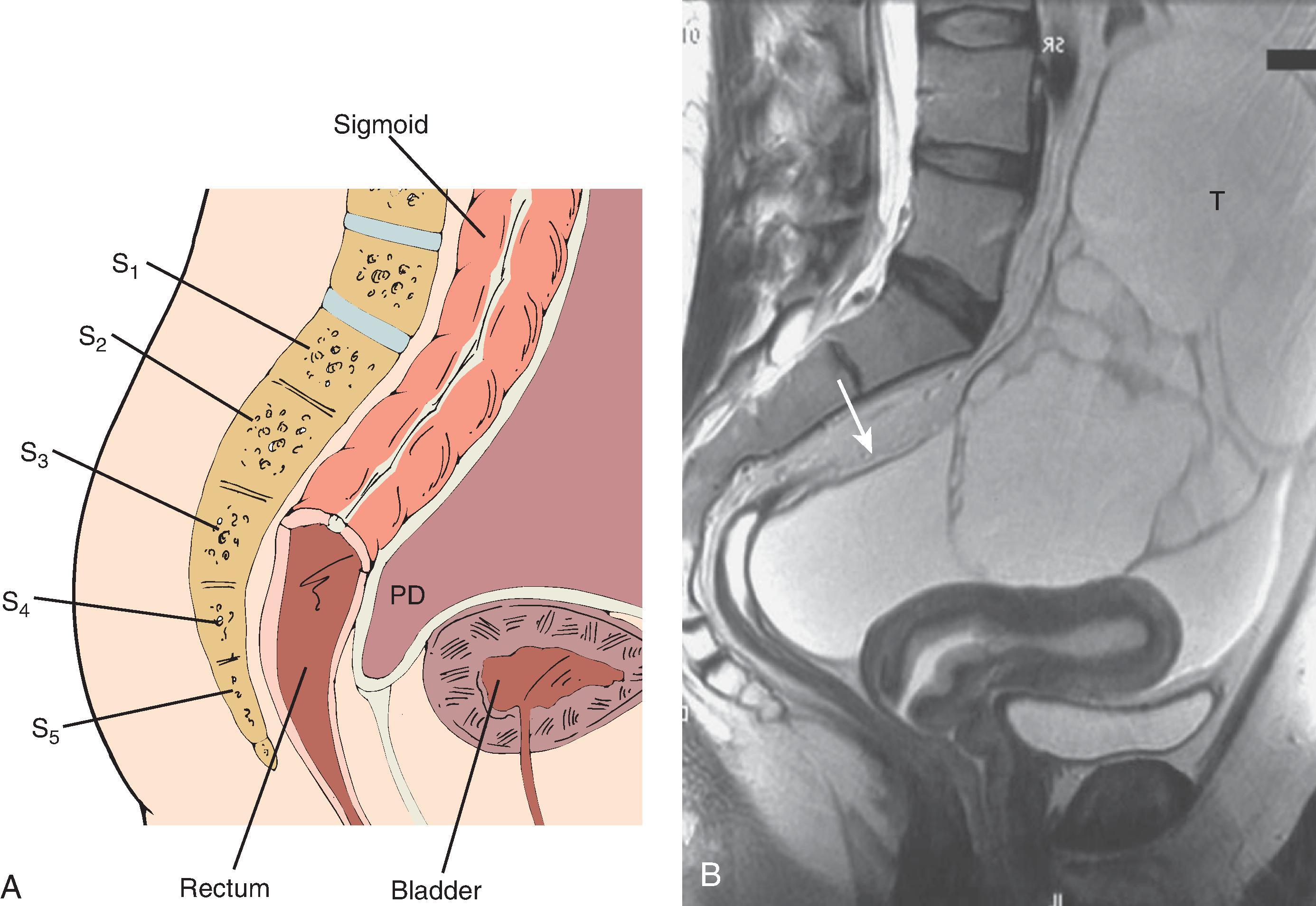 Fig. 64.4, Pouch of Douglas.