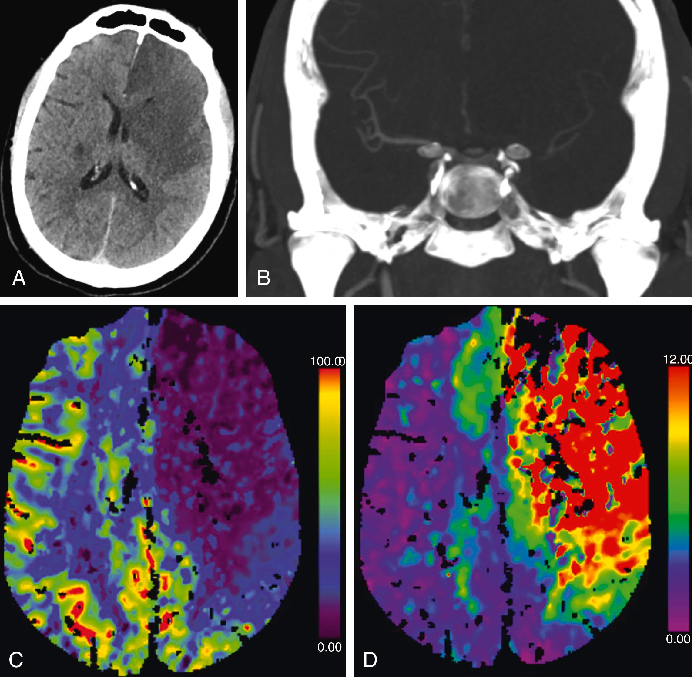 Figure 24.1, A. Initial axial head CT without contrast in the ED demonstrates a large left frontotemporal hypodensity without significant midline shift. B. Coronal maximal intensity projections of a head CTA demonstrates non-opacification of the left ICA termination. C. Cerebral blood flow color map demonstrates a large ischemic core in the left ACA and MCA territories. D. Tmax color map demonstrates almost complete overlap with the cerebral blood flow deficit, indicating minimal penumbra.